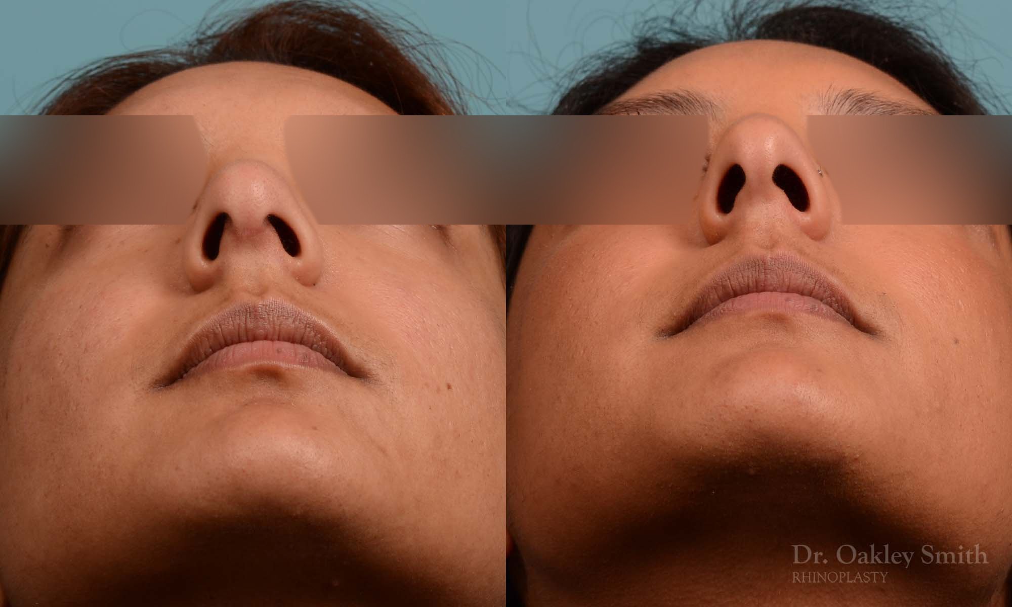 271F-rhinoplasty-dr-oakley-smith-toronto-nose-job.jpg