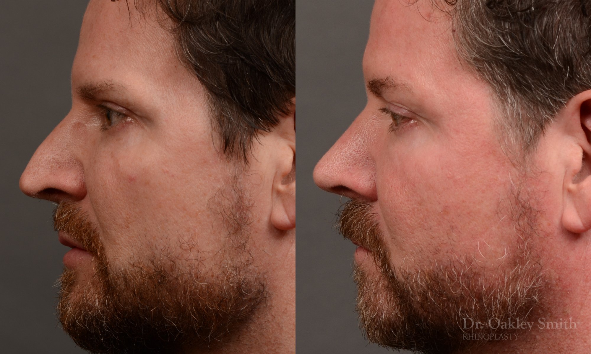 Case 560, Dr. Oakley Smith, male rhinoplasty, 12 months after surgery, left profile view