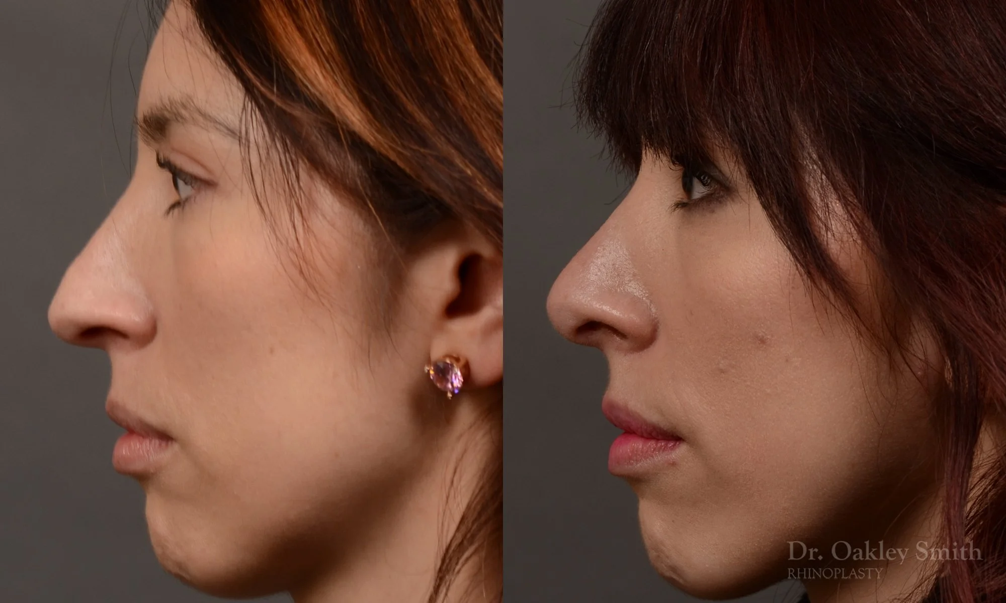 525E-rhinoplasty-dr-oakley-smith-toronto-top-surgeon-nose-job.jpg