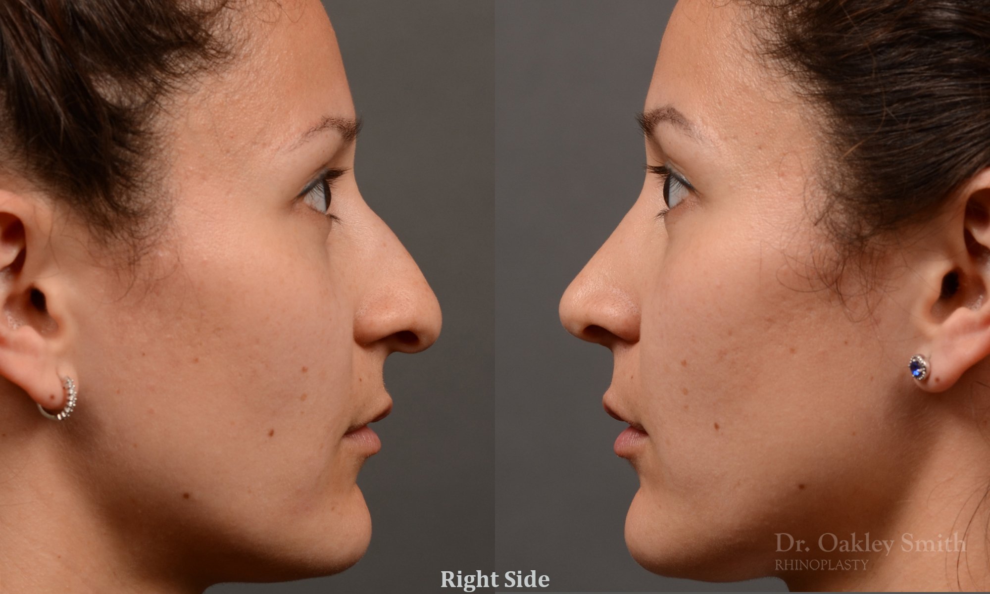 332: Female, Ethnic Rhinoplasty, Dorsal Hump, Crooked, Tip Refinement