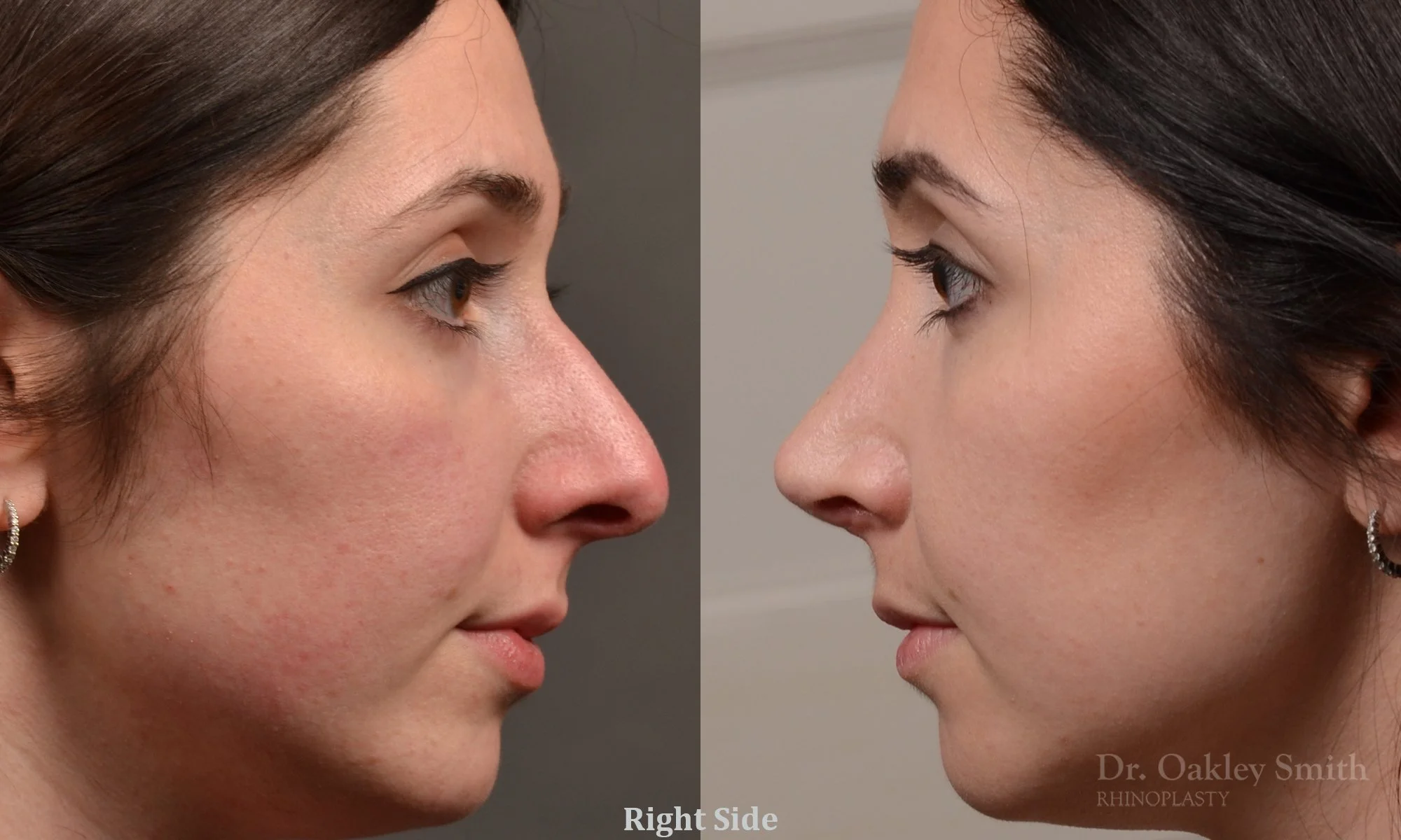 476C-rhinoplasty-dr-oakley-smith-toronto-top-surgeon-nose-job.jpg