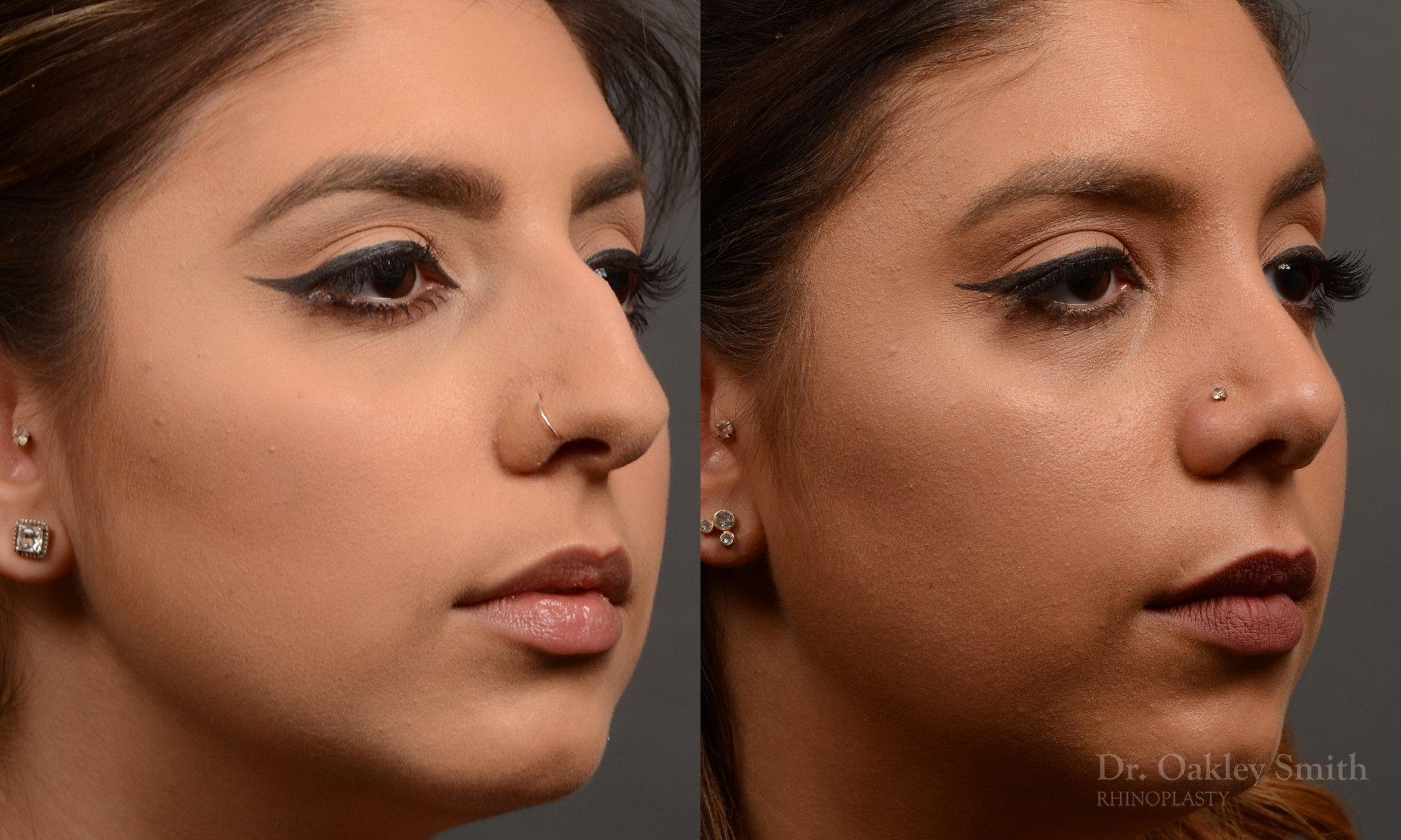 350B-rhinoplasty-dr-oakley-smith-toronto-nose-job - Copy.jpg