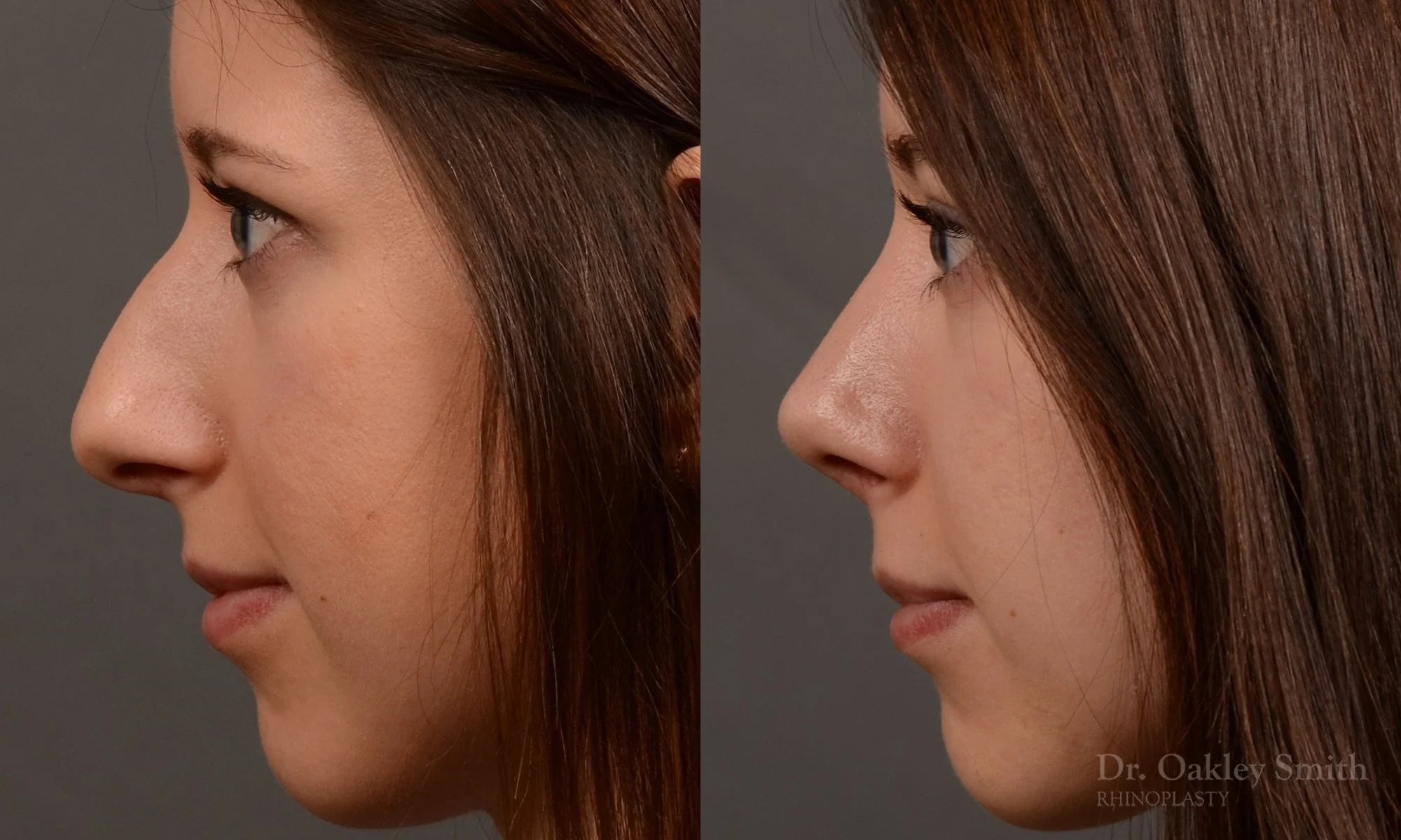 516E-rhinoplasty-dr-oakley-smith-toronto-top-surgeon-nose-job.jpg