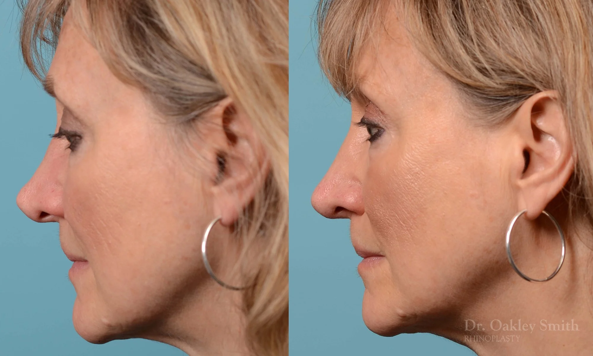 225E-rhinoplasty-dr-oakley-smith-nose-job-curved-nose-columellar-long-nose-1.jpg