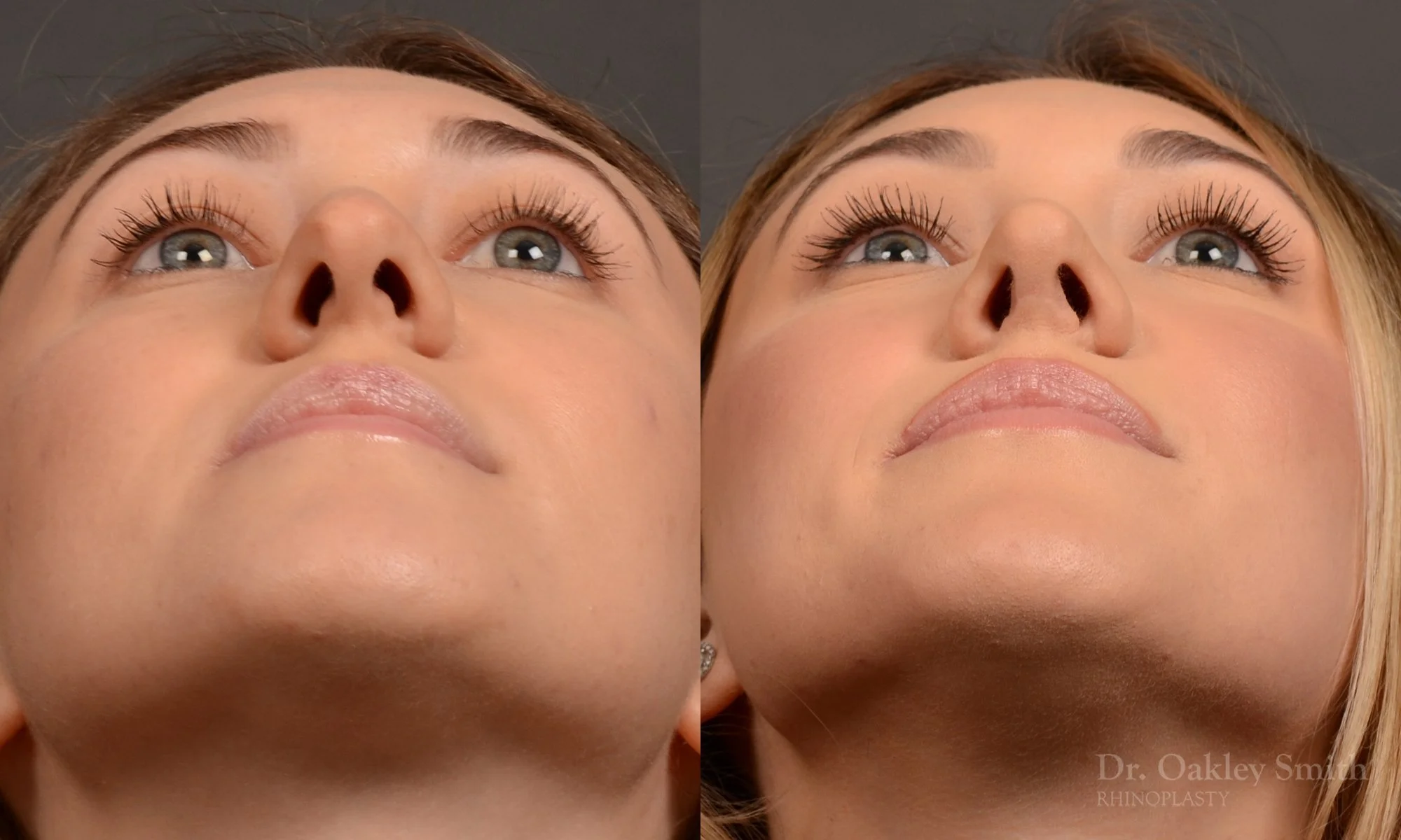 497F-rhinoplasty-dr-oakley-smith-toronto-top-surgeon-nose-job.jpg