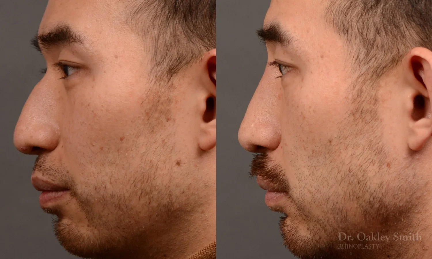 552E-rhinoplasty-filler-nose-job-toronto-nose-surgeon-dr-oakley-smith.webp