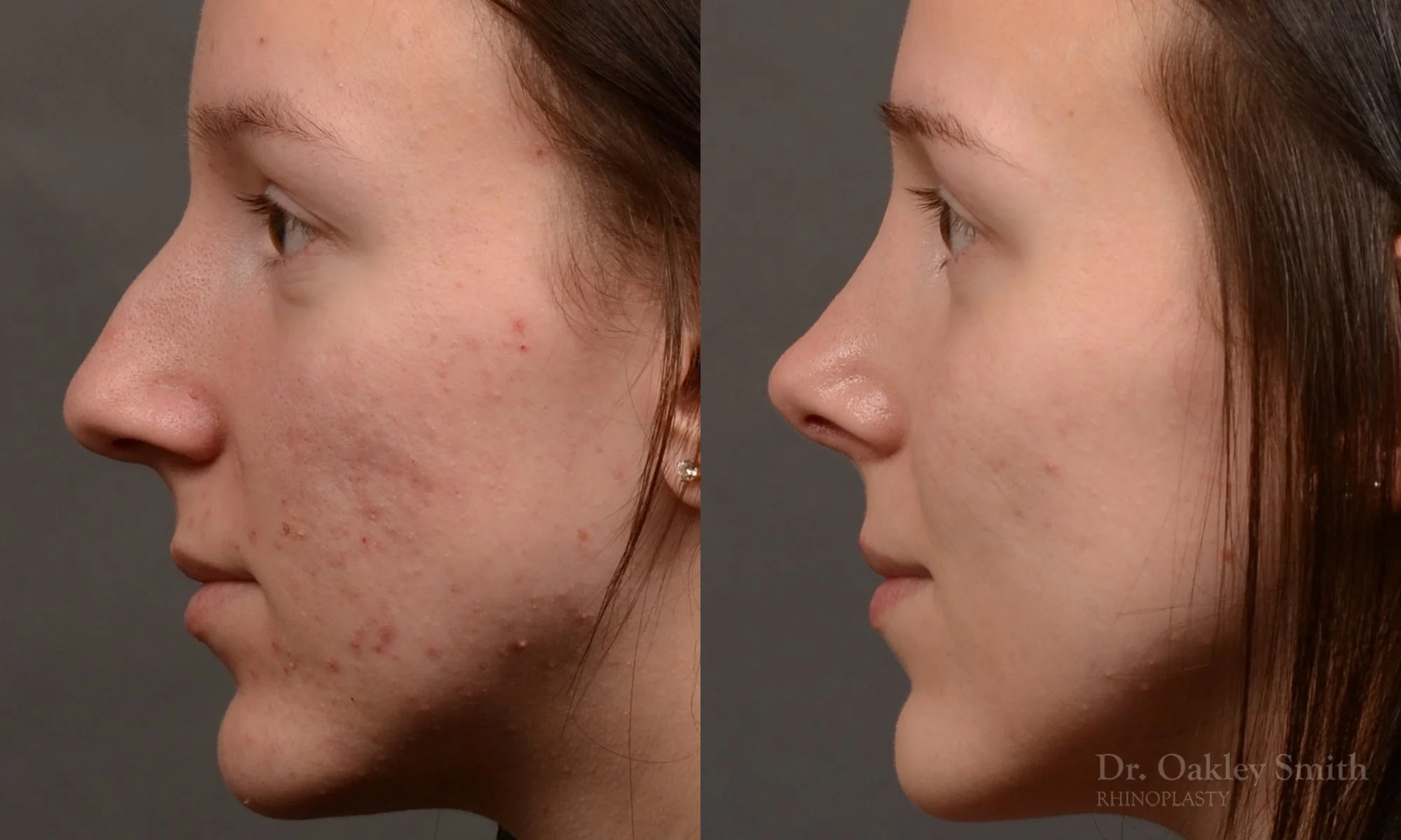 511E-rhinoplasty-dr-oakley-smith-toronto-top-surgeon-nose-job.jpg