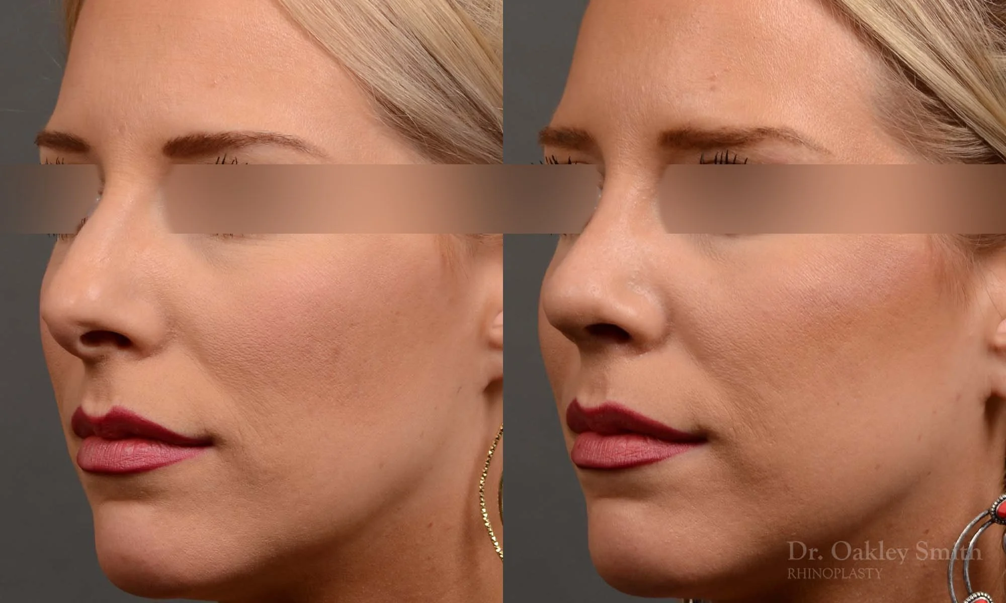 307D-rhinoplasty-dr-oakley-smith-nose-job-toronto.jpg