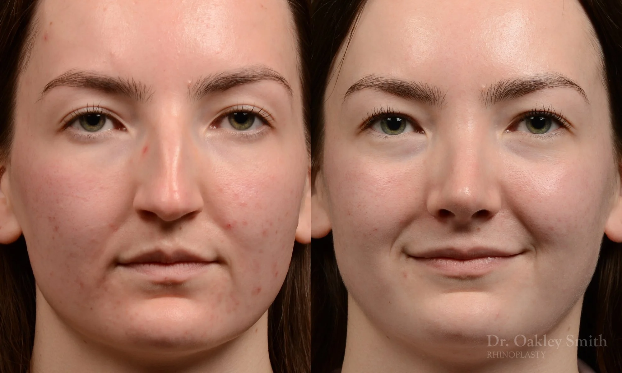 556A rhinoplasty, nose job, toronto nose surgeon, dr oakley smith.jpg