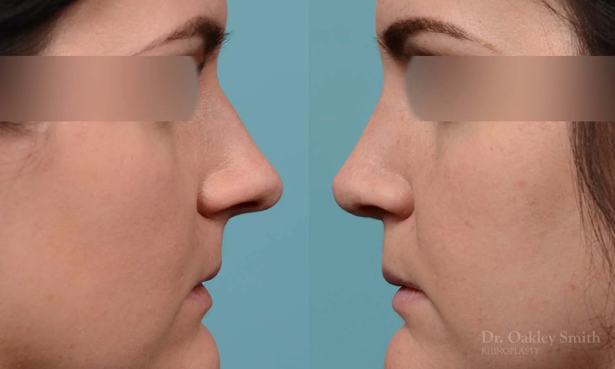 252C-rhinoplasty-dr-oakley-smith-toronto-nose-job.jpg