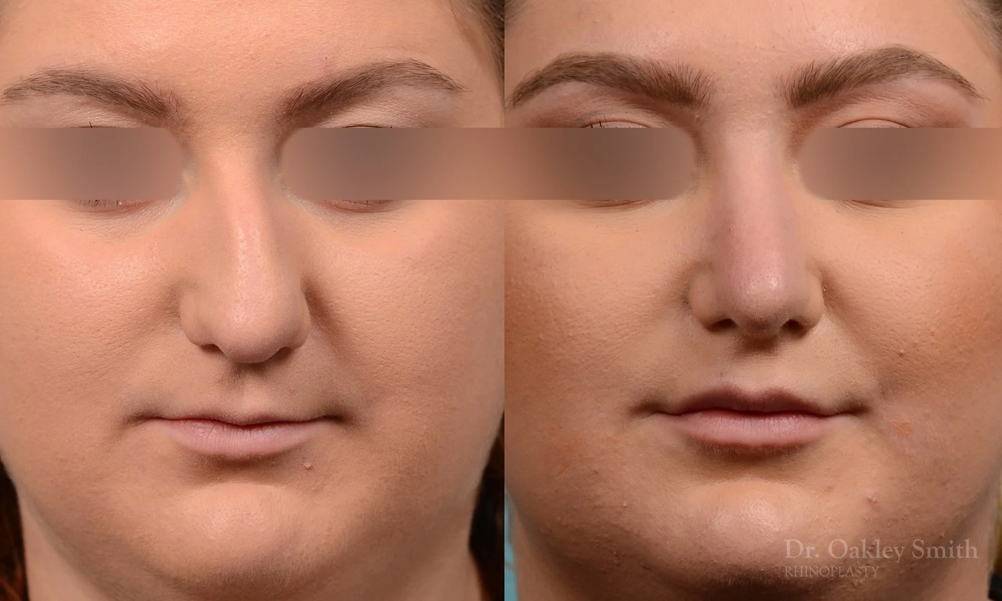 235A-watermark-curved-nose-nose-job-dr-oakley-smith-toronto-rhinoplasty-bump-on-bridge.jpg