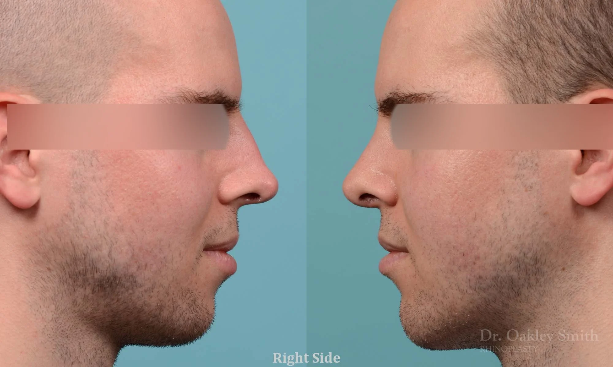 278: Primary Male Rhinoplasty, Normal Skin,  Tip Refinement