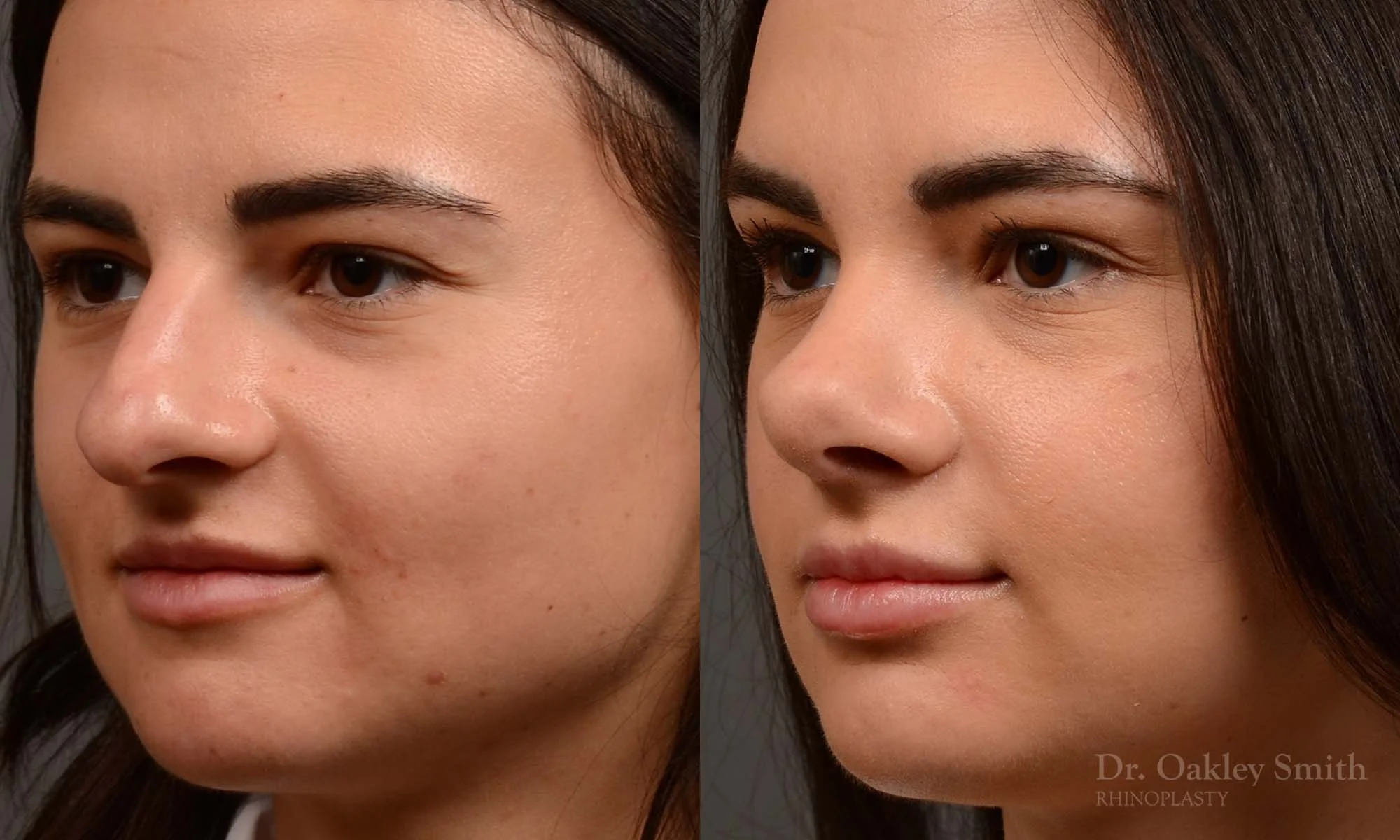 509D-rhinoplasty-dr-oakley-smith-toronto-top-surgeon-nose-job.jpg