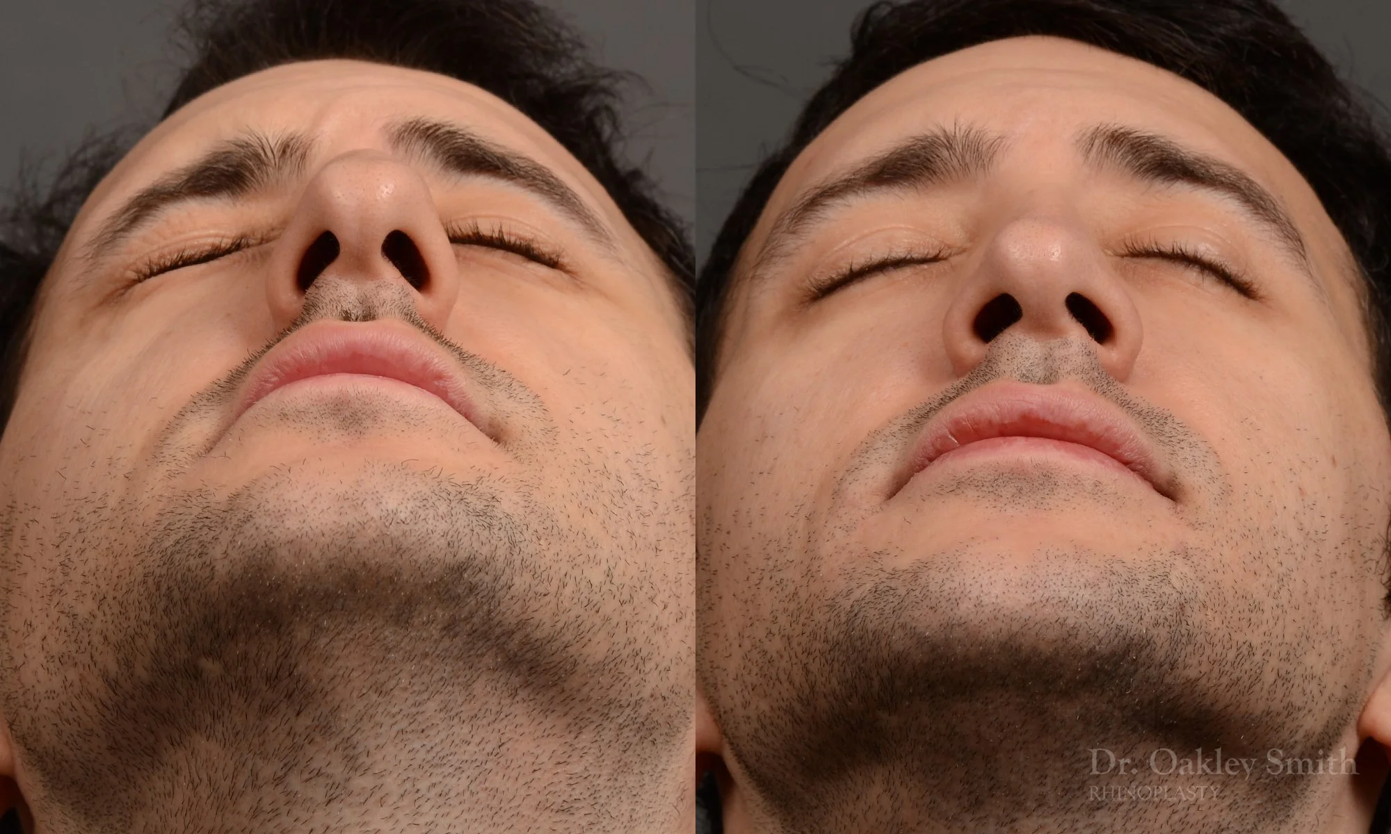 428F-male-rhinoplasty-dr-oakley-smith-toronto-top-surgeon-nose-job.jpg
