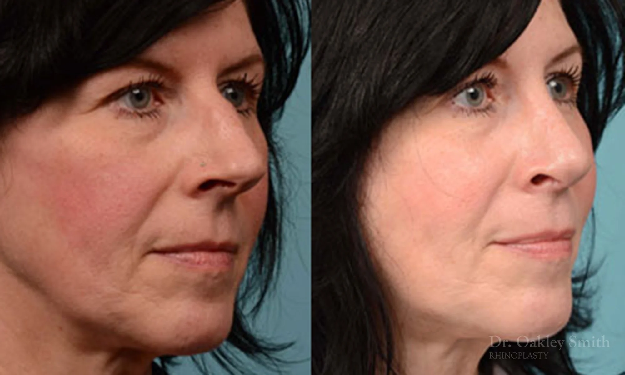 324B-rhinoplasty-dr-oakley-smith-toronto-nose-job.jpg