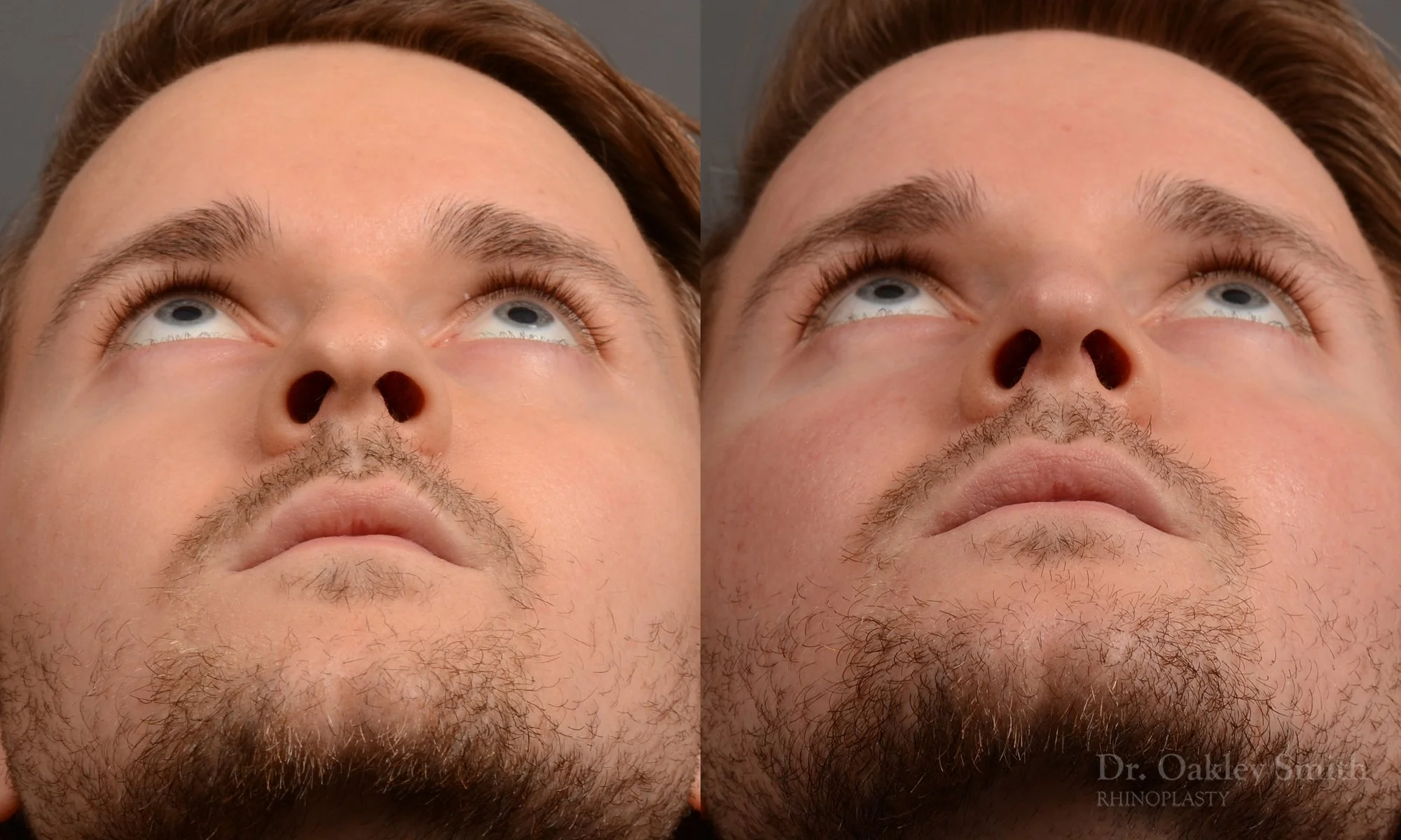 401F-expert-rhinoplasty-surgeon-rhinoplasty-dr-oakley-smith-toronto-nose-job-surgery.jpg