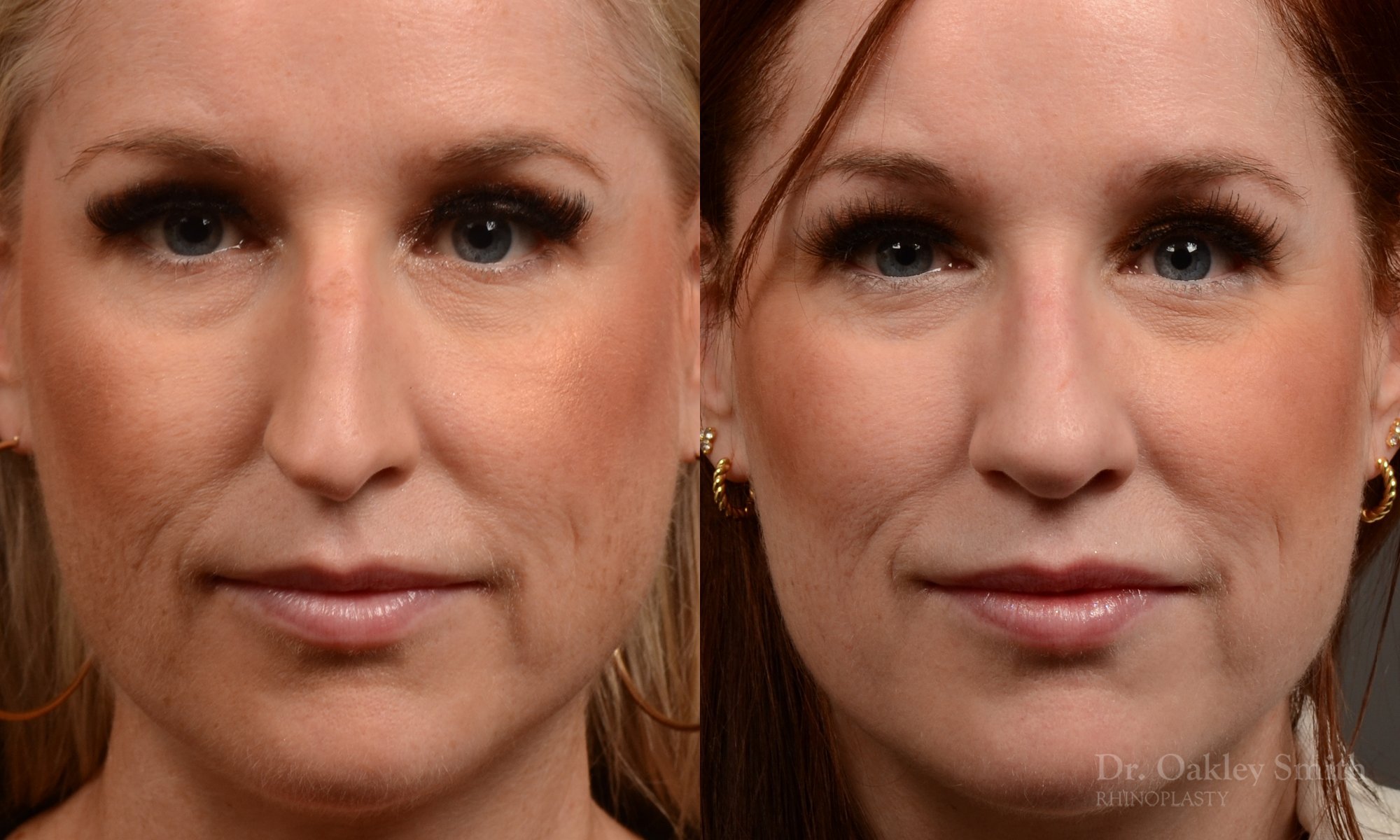 528A-rhinoplasty-dr-oakley-smith-toronto-top-surgeon-nose-job.jpg