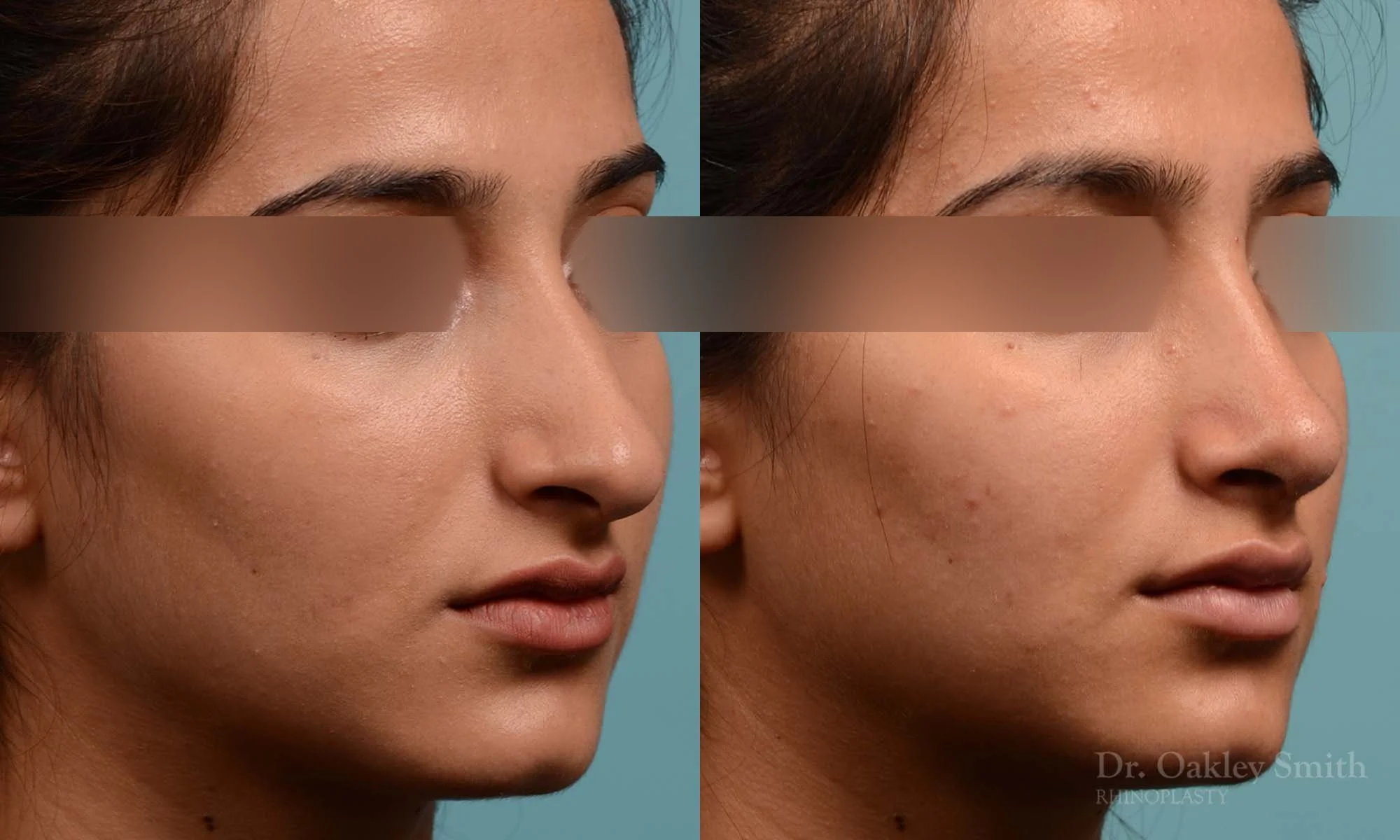 308B-rhinoplasty-dr-oakley-smithm-toronto-nose-job.jpg
