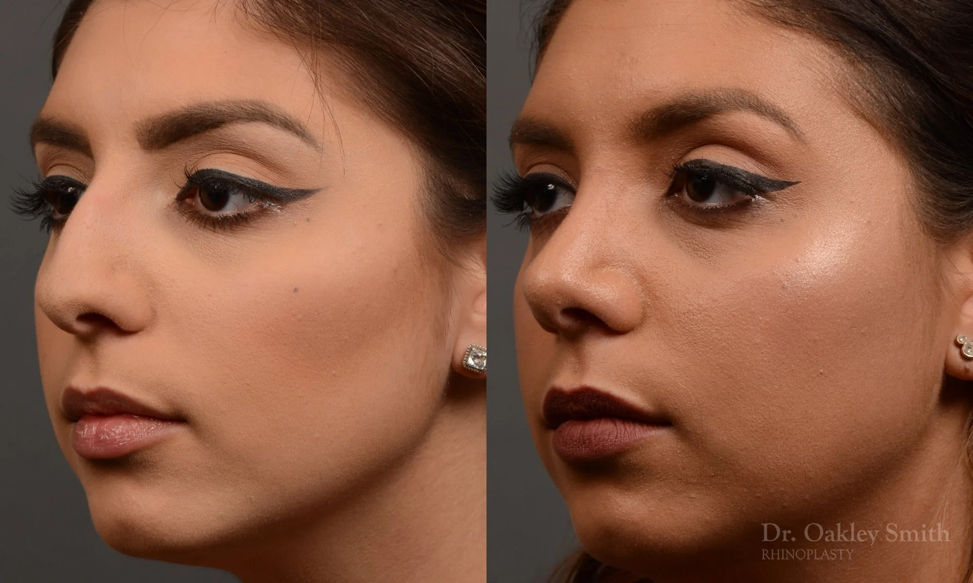 350D-rhinoplasty-dr-oakley-smith-toronto-nose-job - Copy.jpg