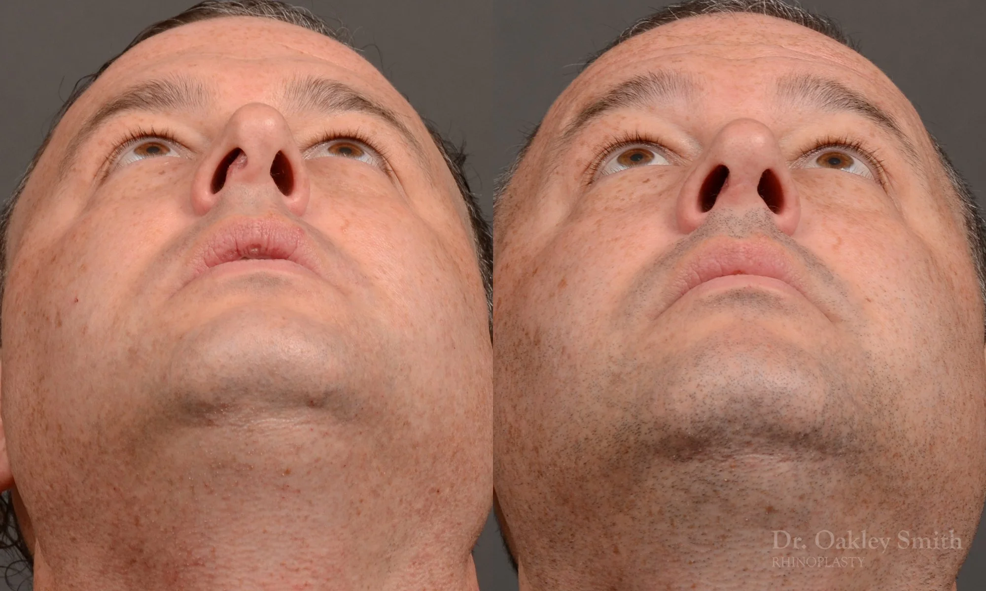 514F-male-rhinoplasty-dr-oakley-smith-toronto-nose-job.jpg