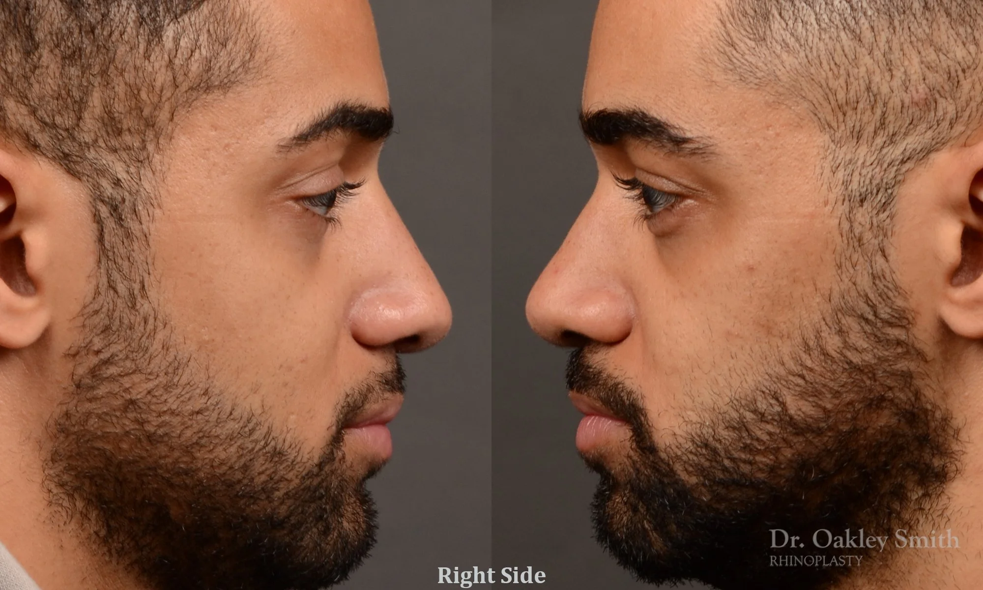 544: Primary Male Rhinoplasty, Normal Skin, Bridge Work, Tip Work, Ethnic Rhinoplasty