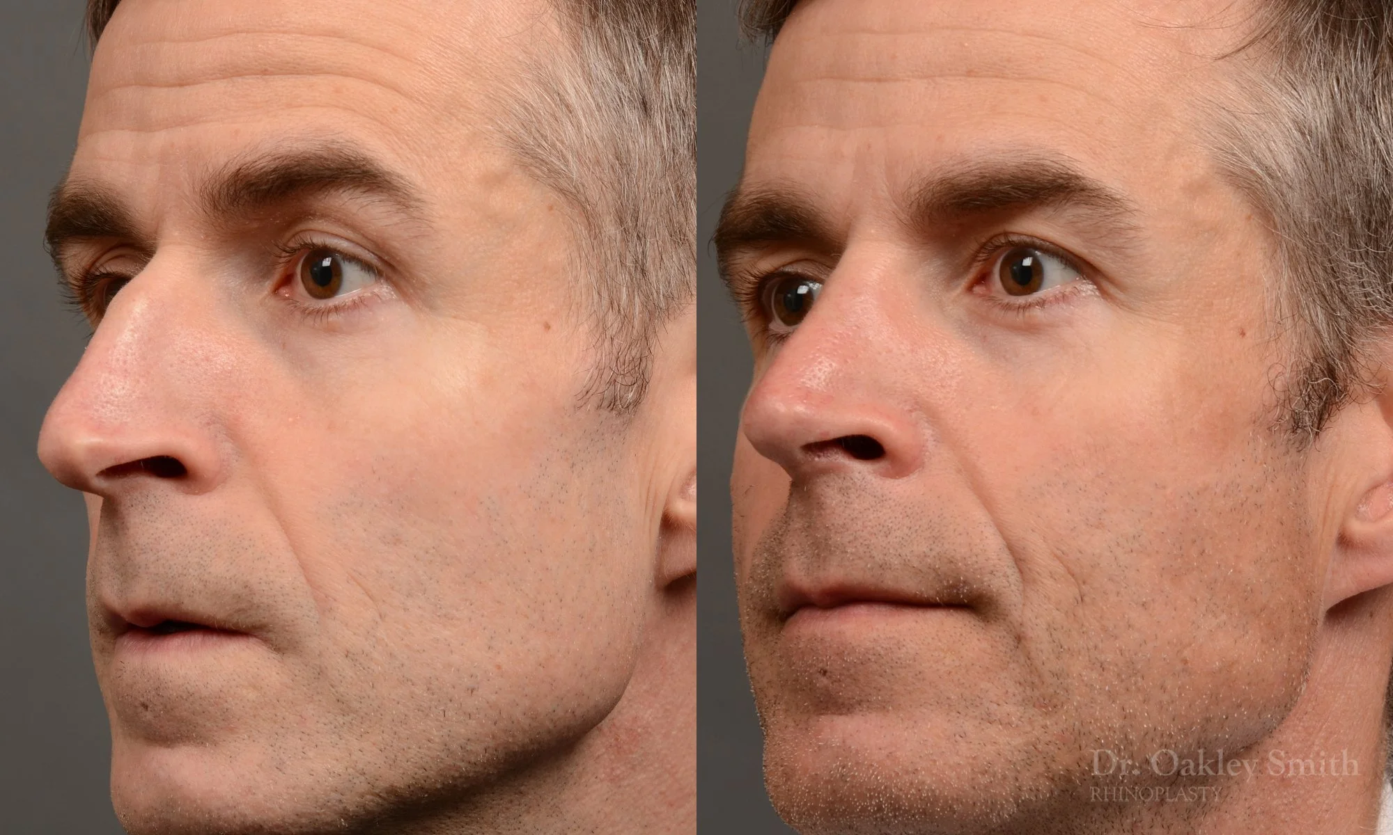 535D-male-rhinoplasty-dr-oakley-smith-toronto-top-surgeon-nose-job.jpg
