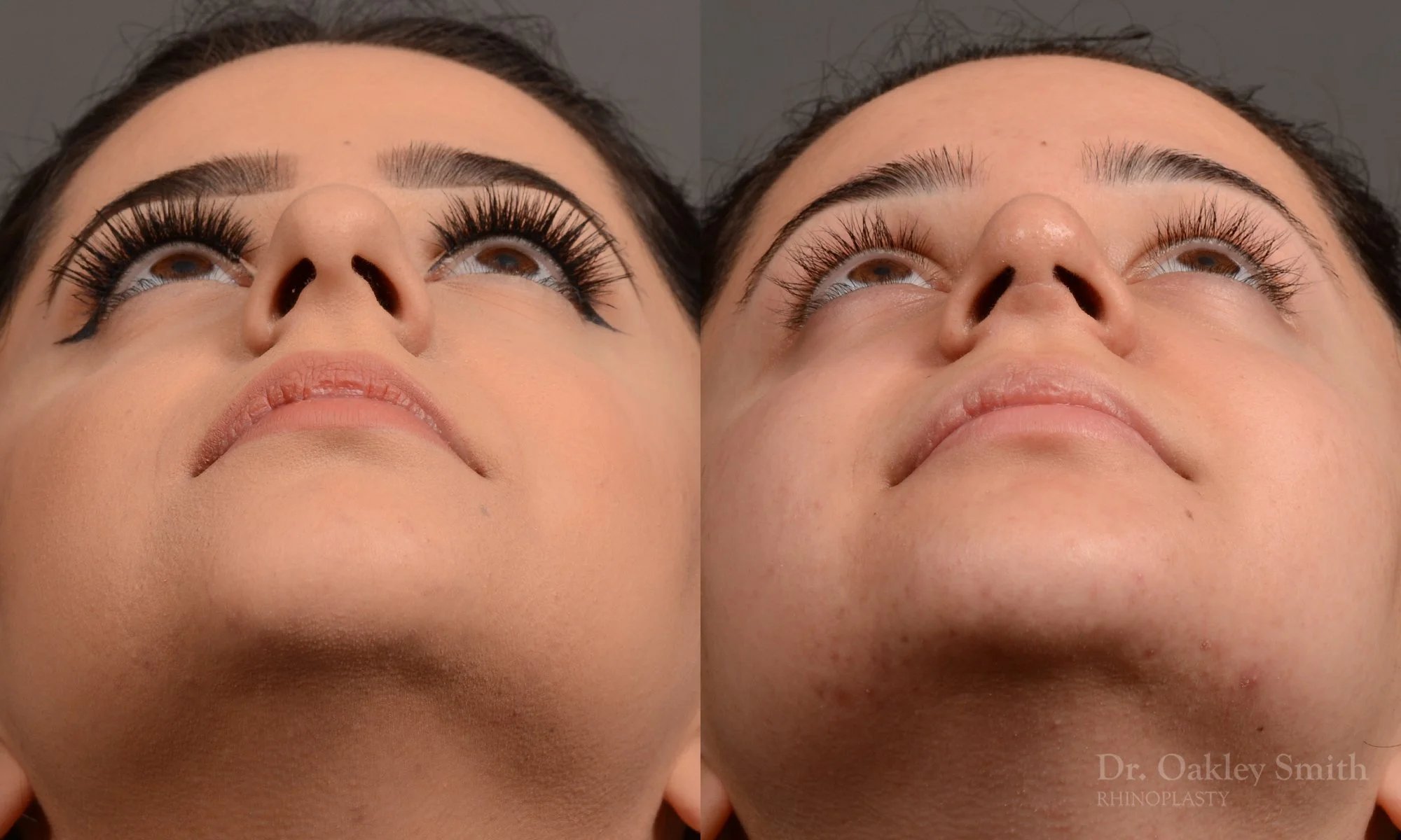 304F-rhinoplasty-dr-oakley-smith-toronto-nose-job.jpg