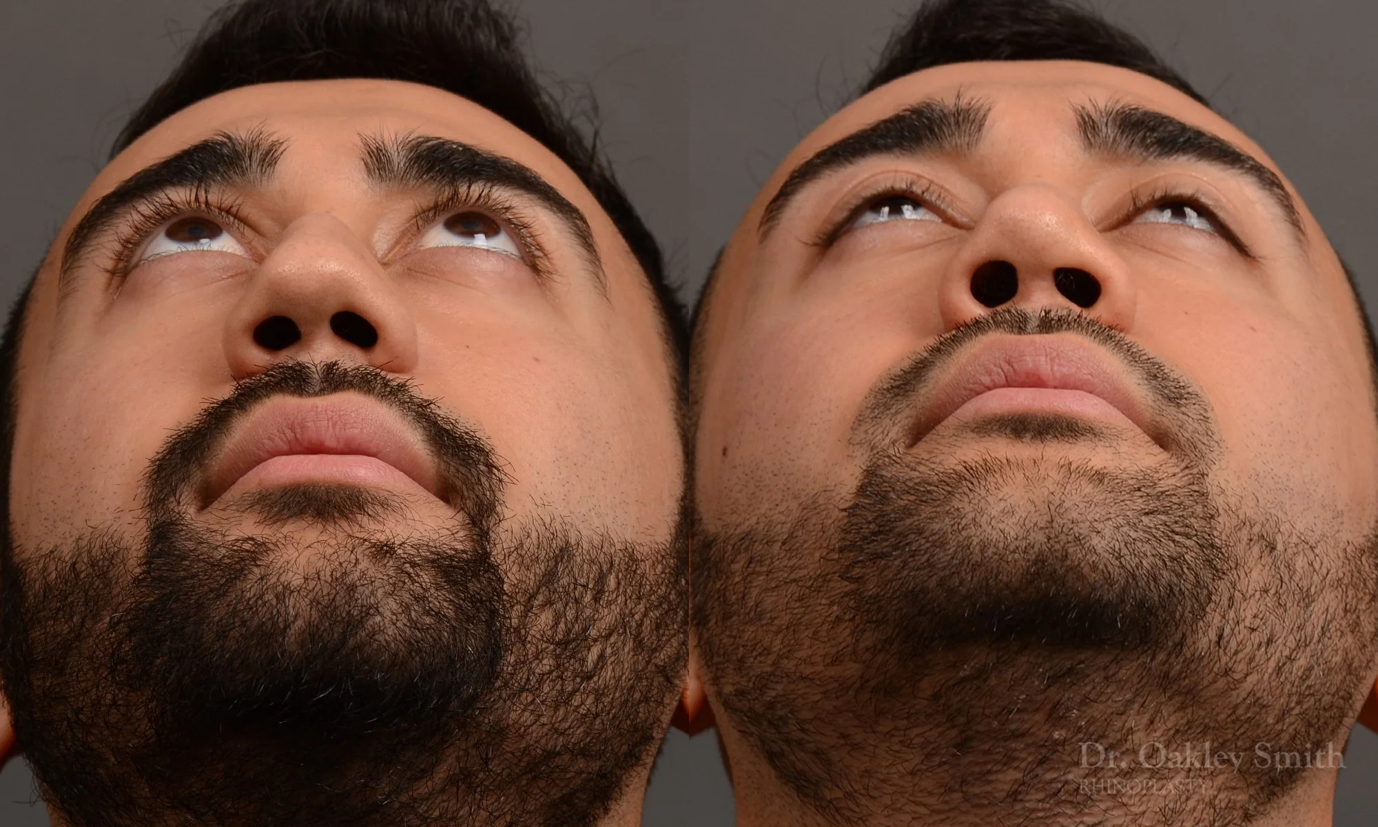 362.1F-rhinoplasty-dr-oakley-smith-toronto-nose-job.jpg