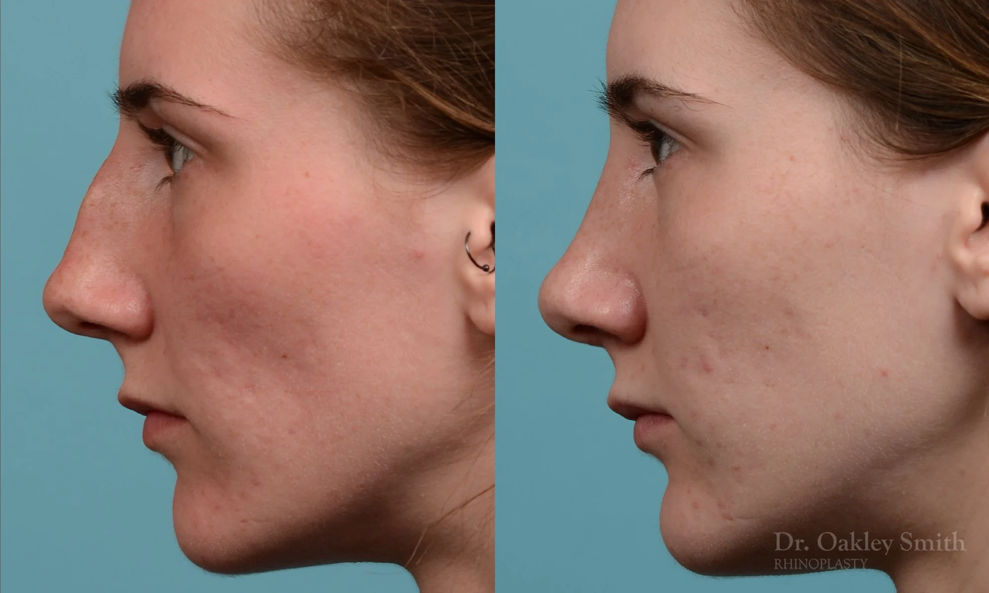248E-rhinoplasty-dr-oakley-smith-toronto-nose-job.jpg