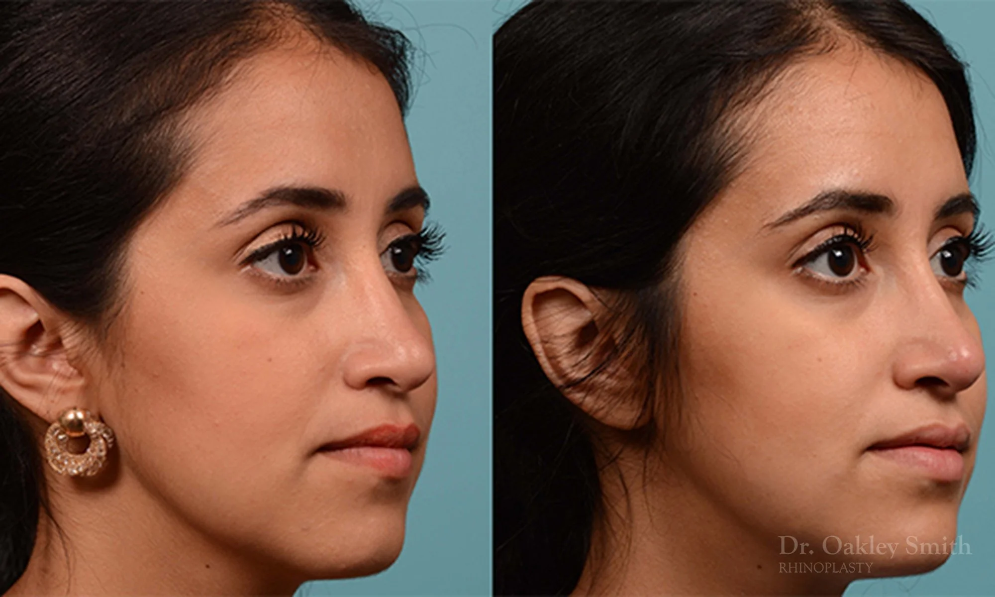 226B-rhinoplasty-dr-oakley-smith-toronto-nose-job-1.jpg