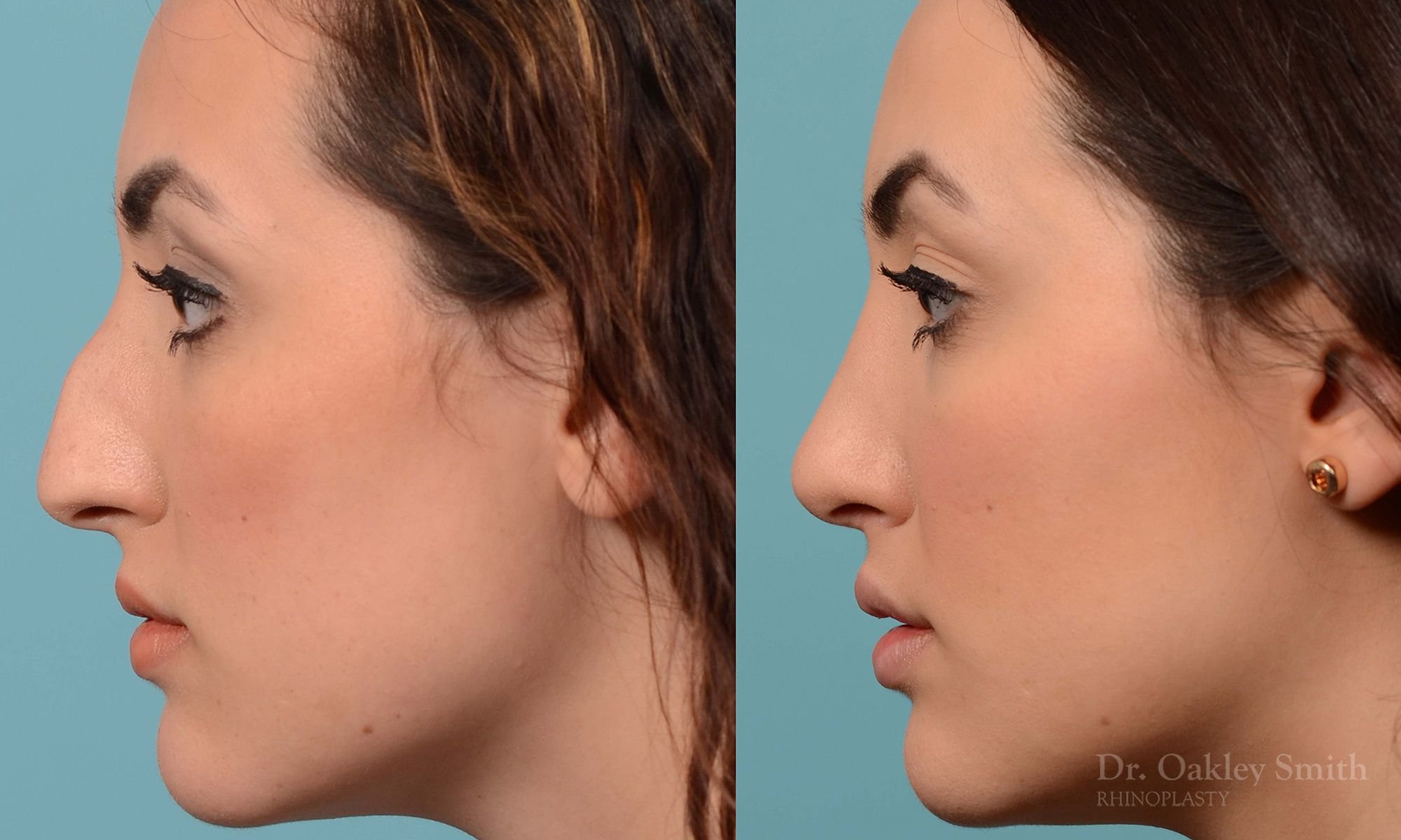 204E-nose-job-big-nose-rhinoplasty-septoplasty-toronto-nose-doctor-dr-oakley-smith-oakley-columellar-show-bump-removed-straight-bridge-5-1.jpg