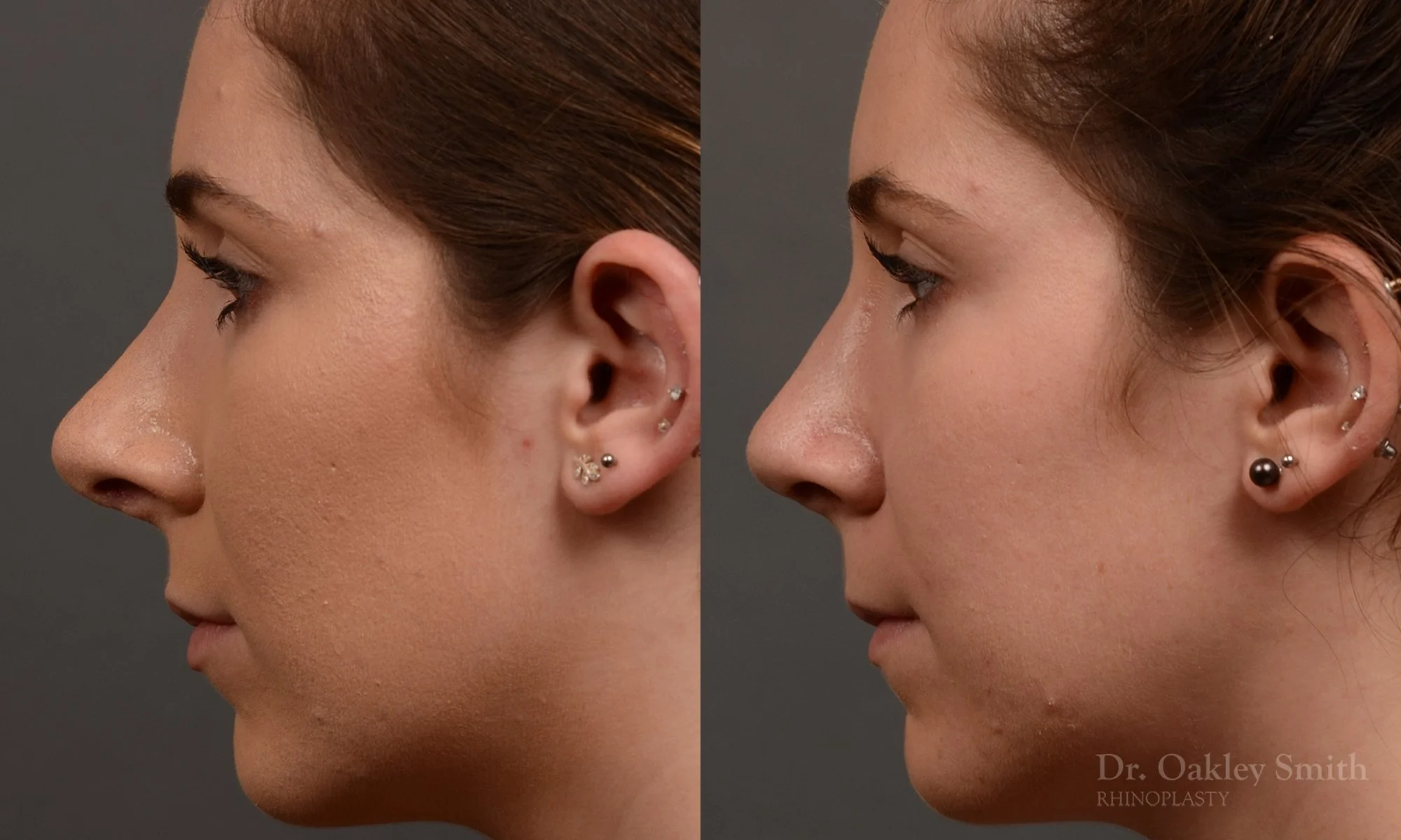366E-rhinoplasty-dr-oakley-smith-toronto-nose-job.jpg