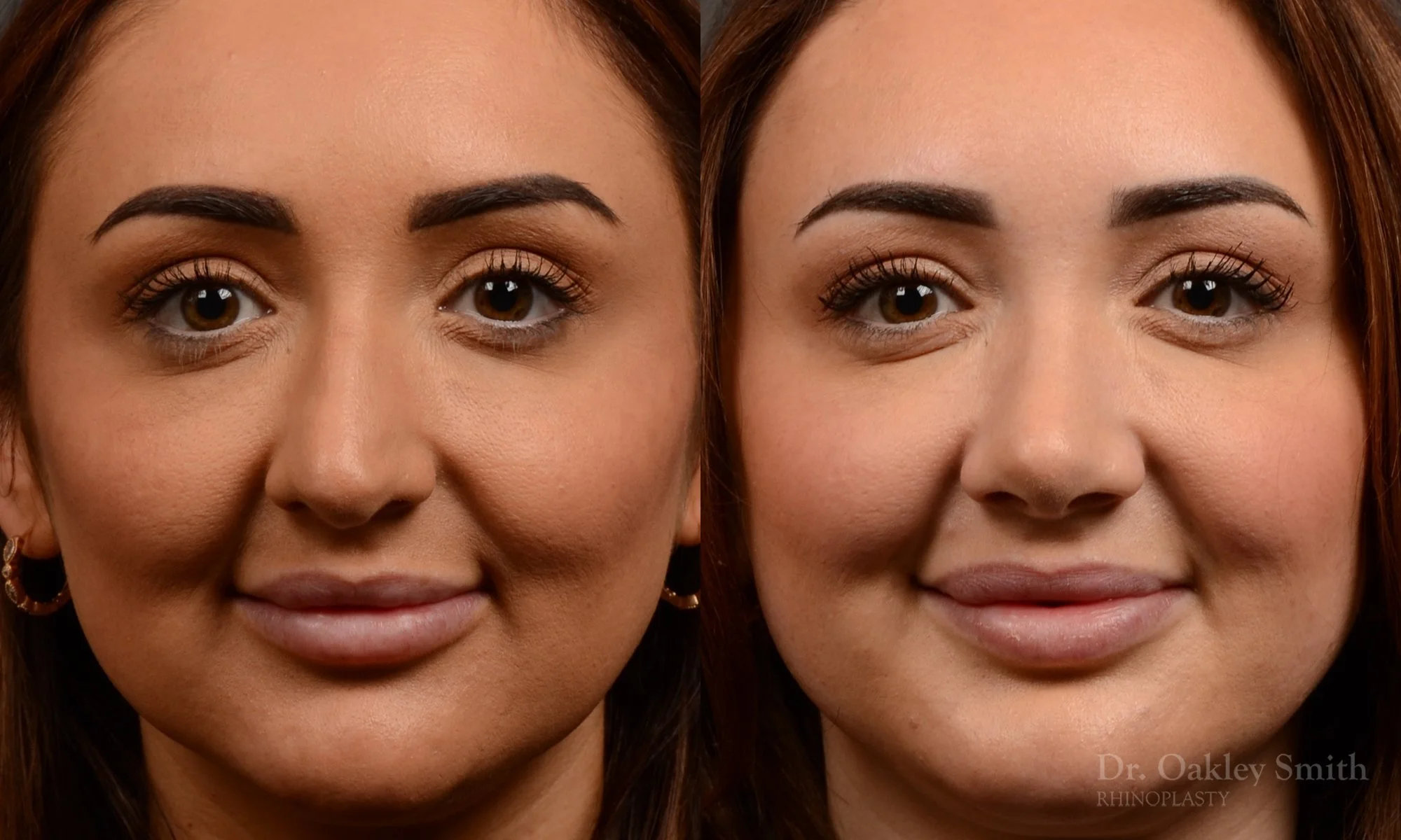 502A-rhinoplasty-dr-oakley-smith-toronto-top-surgeon-nose-job.jpg