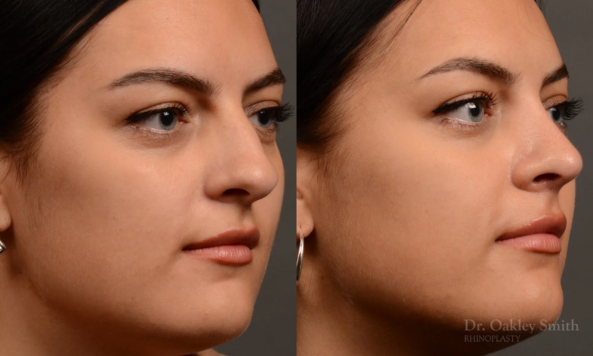 496B-rhinoplasty-dr-oakley-smith-toronto-top-surgeon-nose-job.jpg