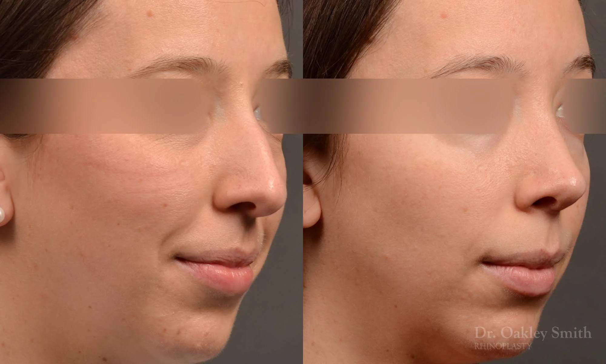 534B-rhinoplasty-dr-oakley-smith-toronto-top-surgeon-nose-job.jpg