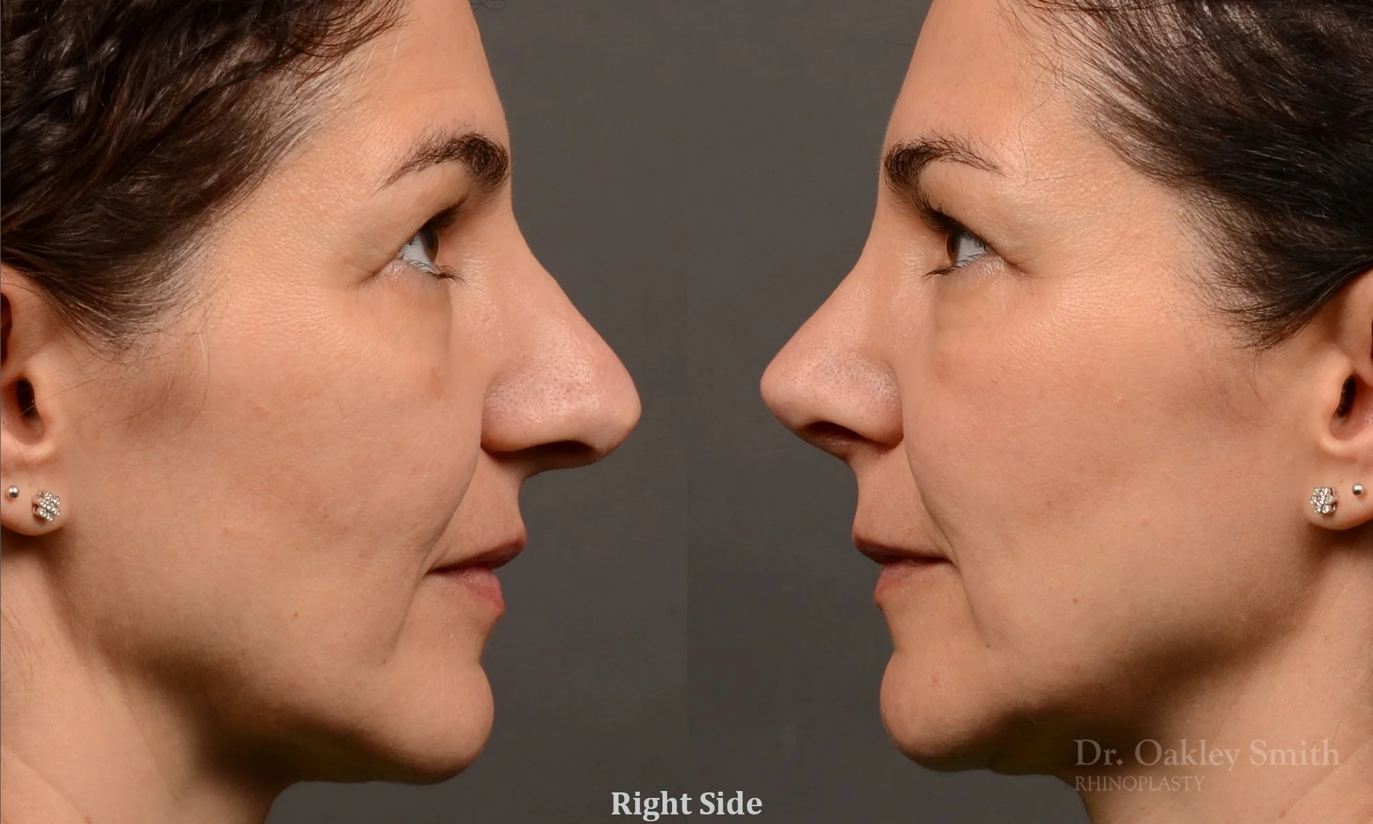 512C-rhinoplasty-dr-oakley-smith-toronto-top-surgeon-nose-job.jpg