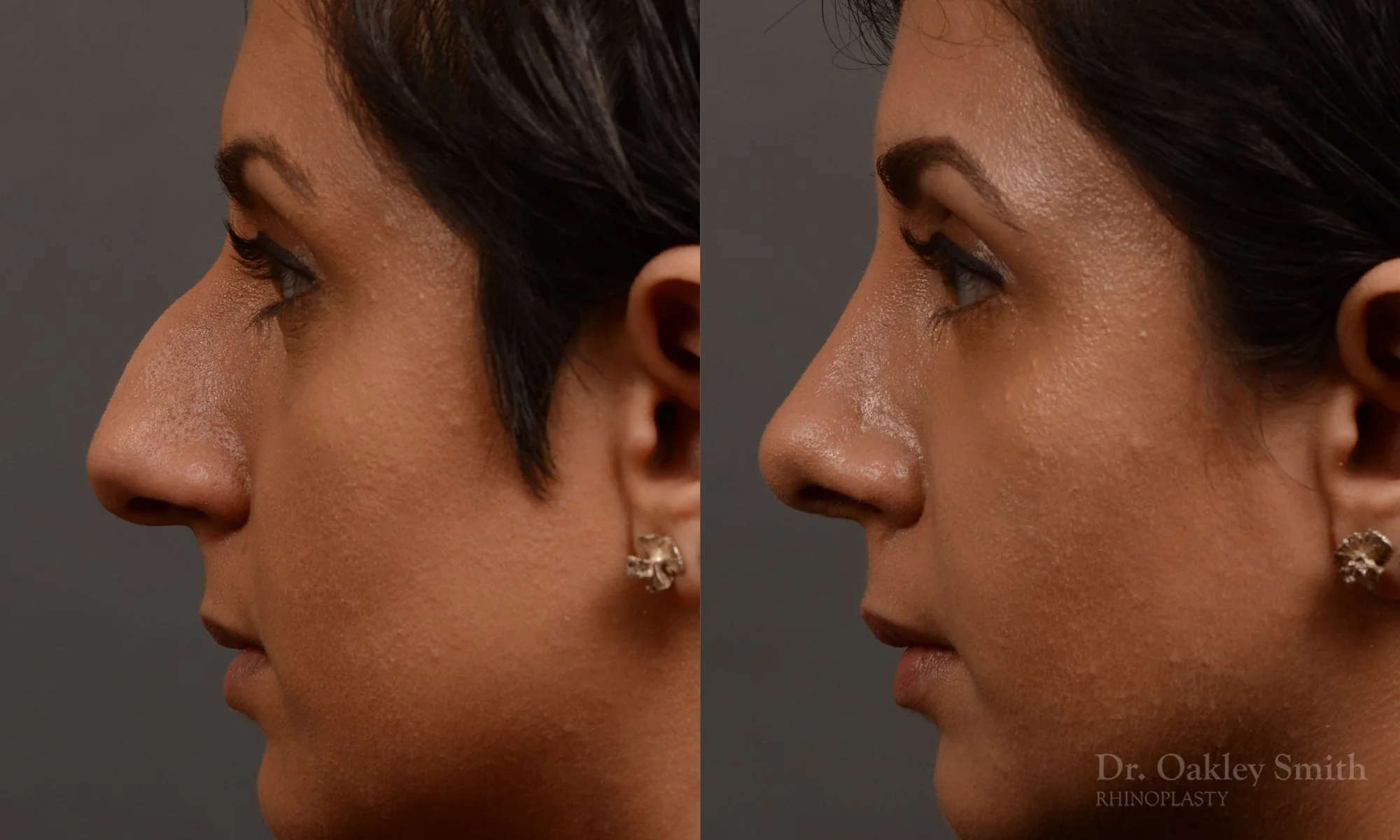 376.1E-rhinoplasty-dr-oakley-smith-toronto-nose-job.jpg