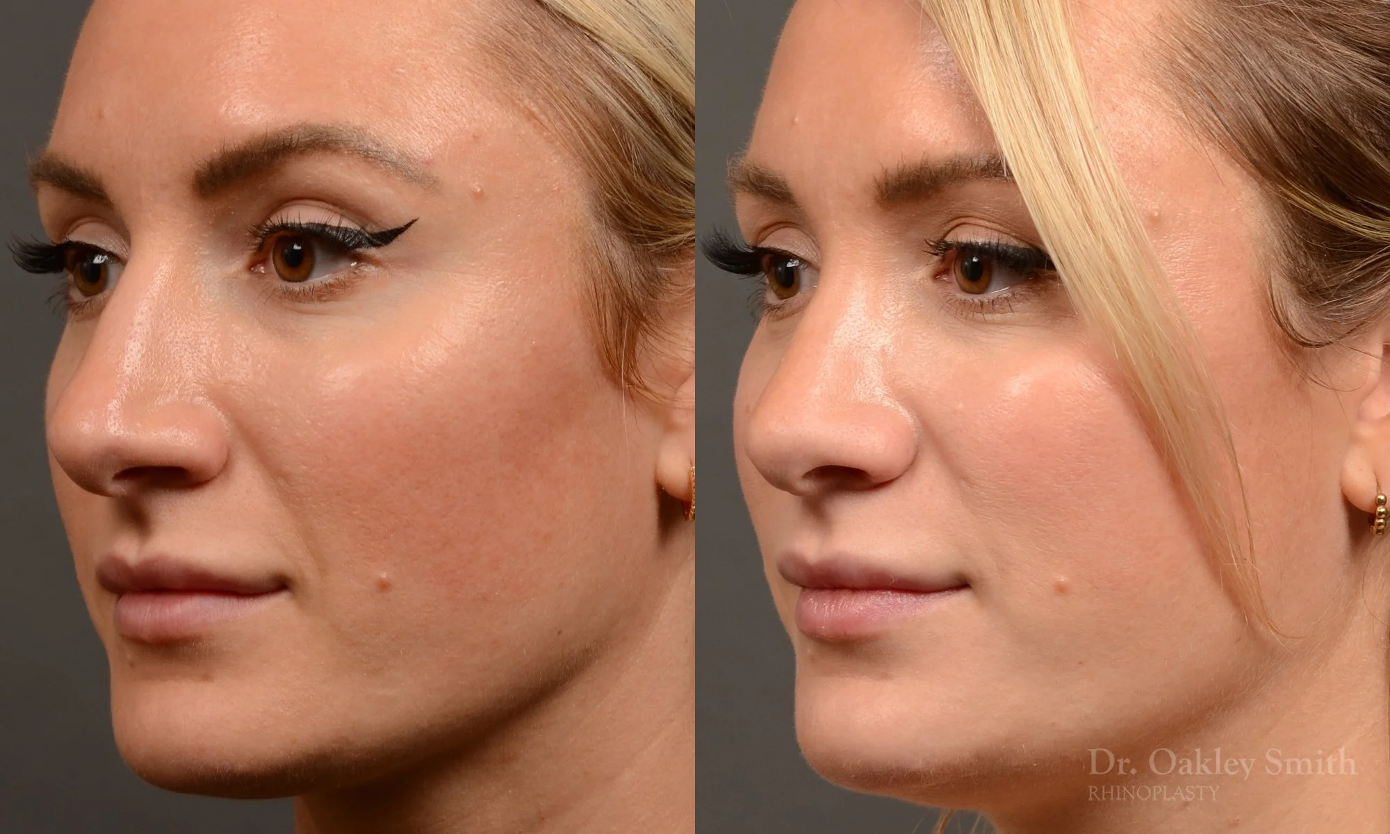 550D-rhinoplasty-nose-job-toronto-nose-surgeon-dr-oakley-smith.jpg