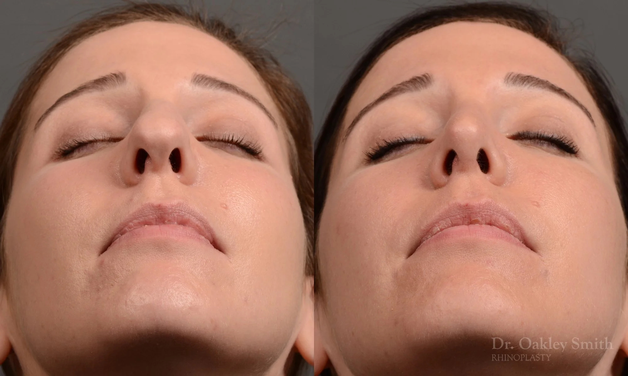 357F-rhinoplasty-dr-oakley-smith-toronto-nose-job.jpg