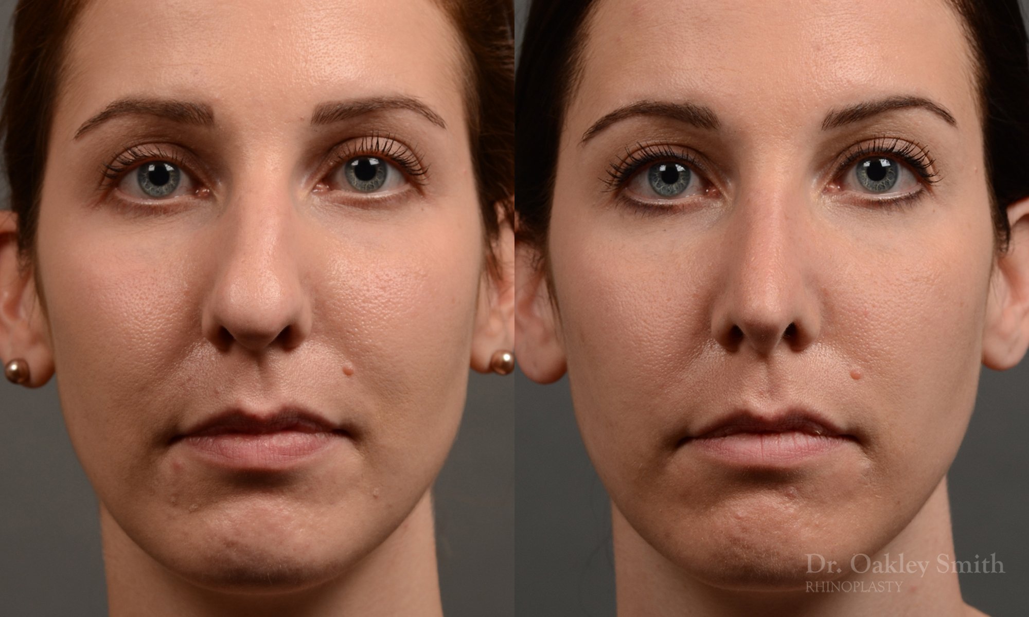 357A-rhinoplasty-dr-oakley-smith-toronto-nose-job.jpg