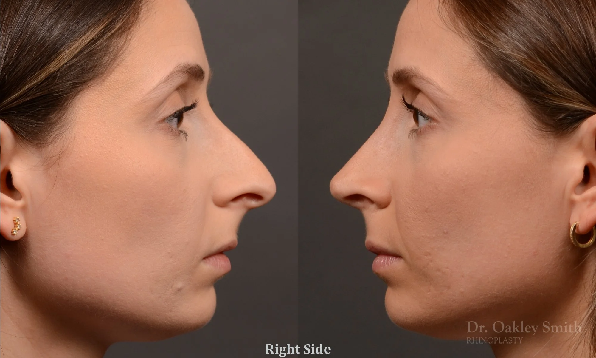 541: Female, Primary Rhinoplasty, Thin Skin, Large Nose, Dorsal Hump, Tip Work