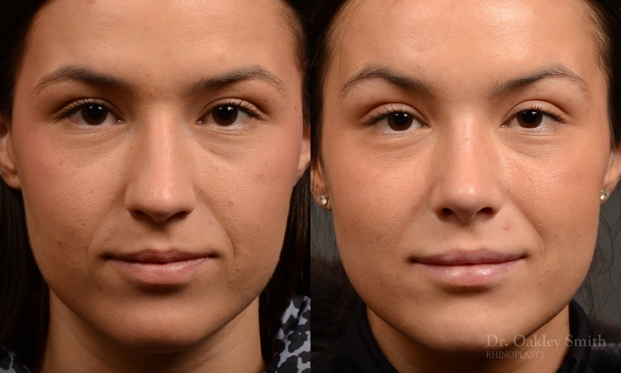 549A-rhinoplasty-nose-job-toronto-nose-surgeon-dr-oakley-smith.jpg