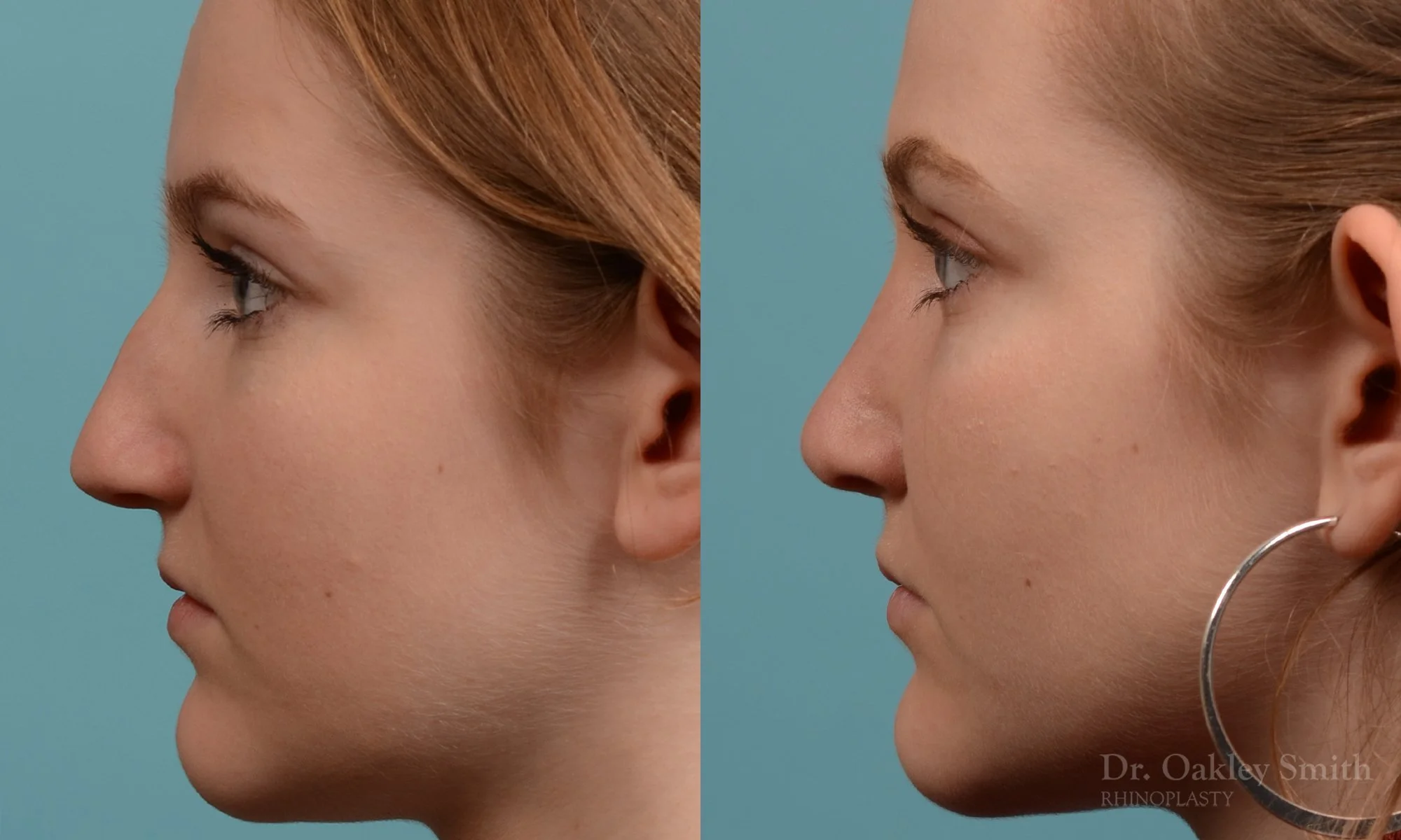 314E-rhinoplasty-dr-oakley-smith-toronto-nose-job.jpg