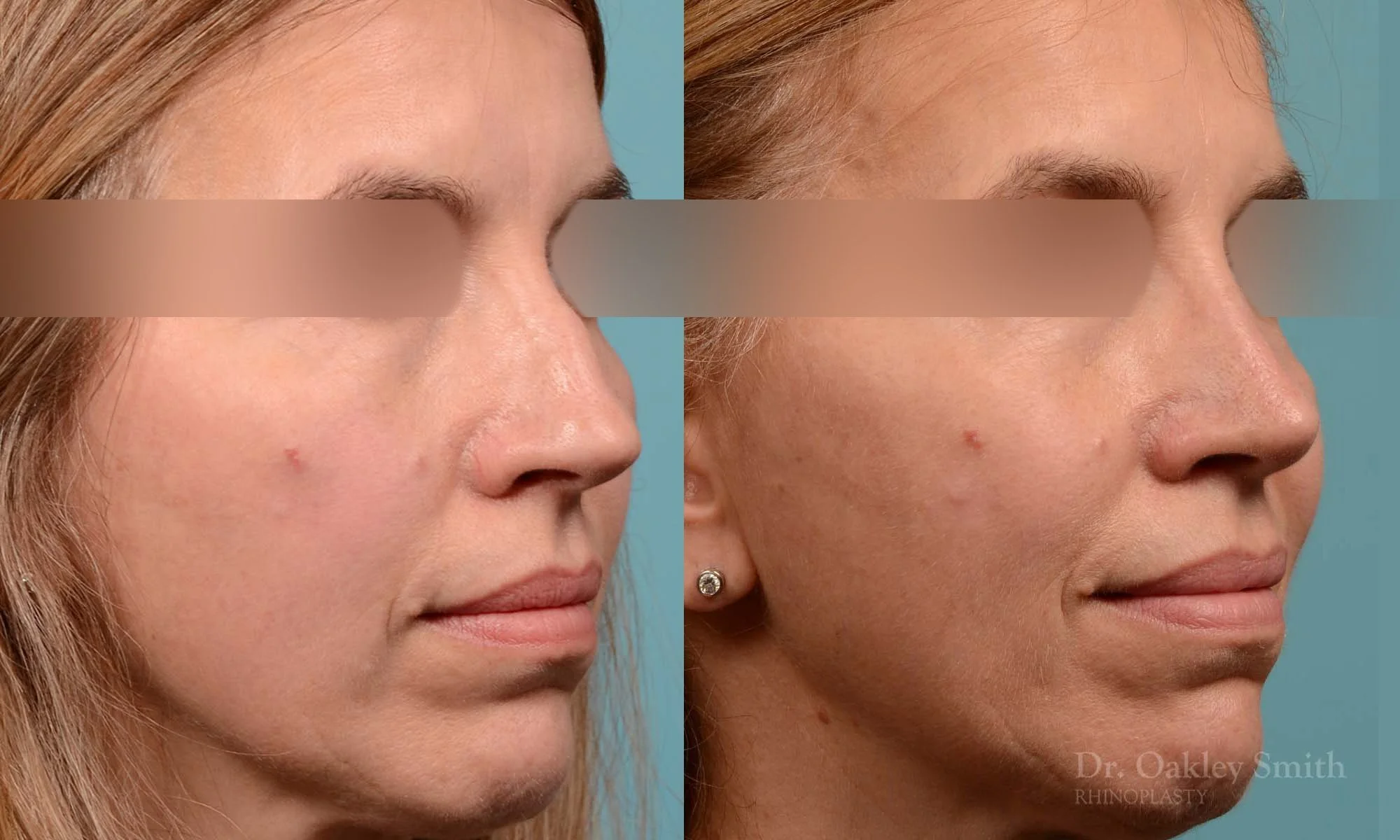 291B-rhinoplasty-dr-oakley-smith-toronto-nose-job.jpg