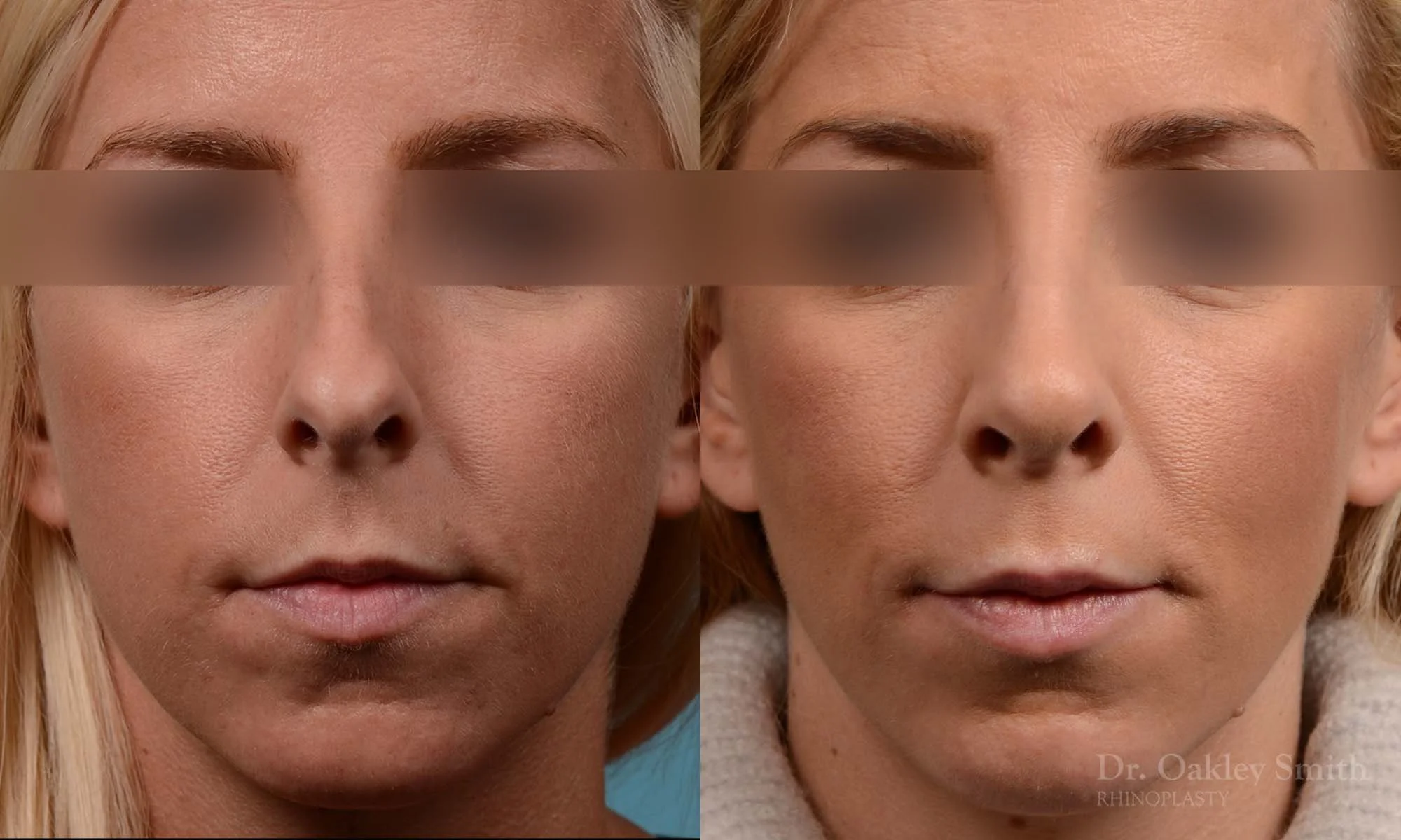 242A-rhinoplasty-dr-oakley-smith-toronto-nose-job-2.jpg
