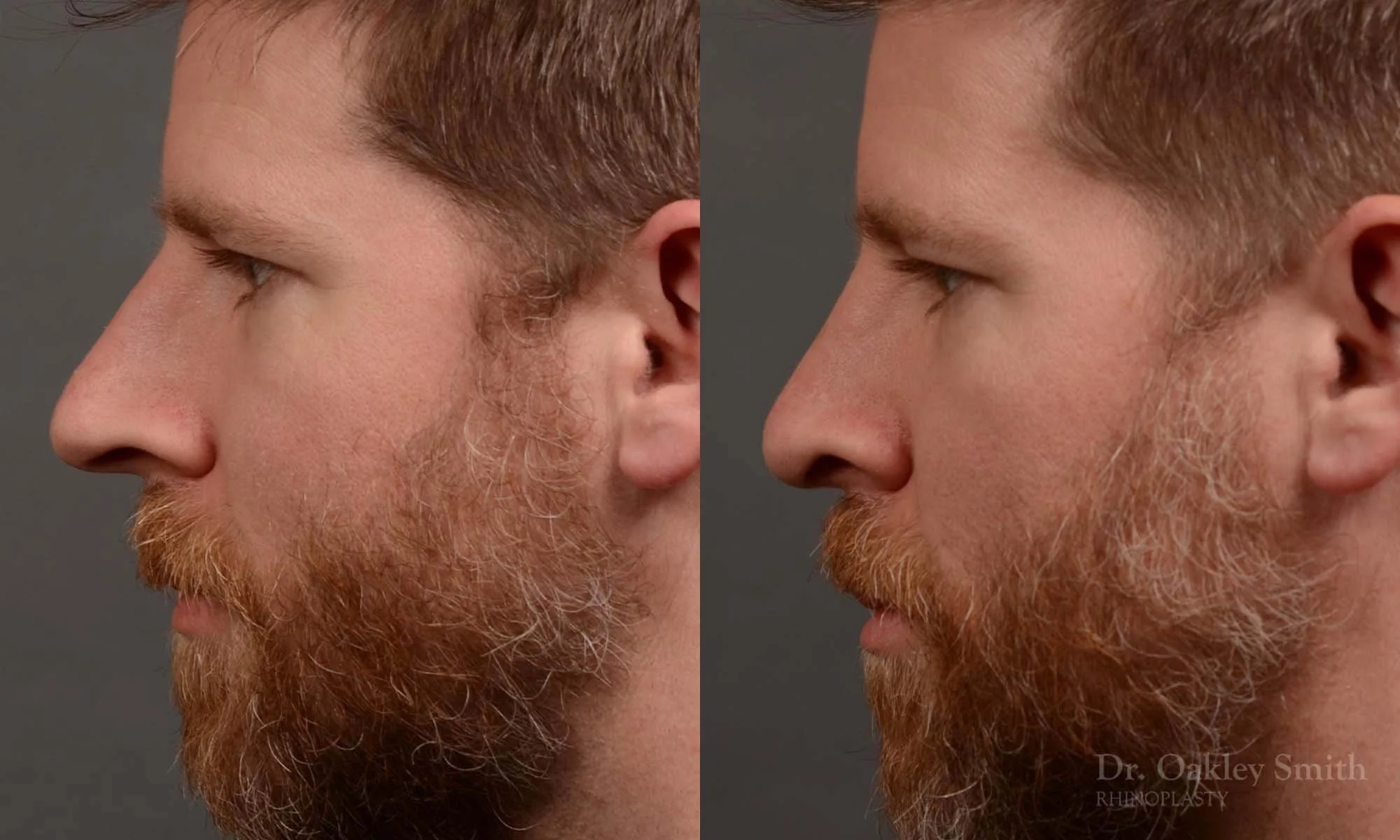 379E-Rhinoplasty-dr-oakley-smith-toronto-male-long-nose-nose-job.jpg