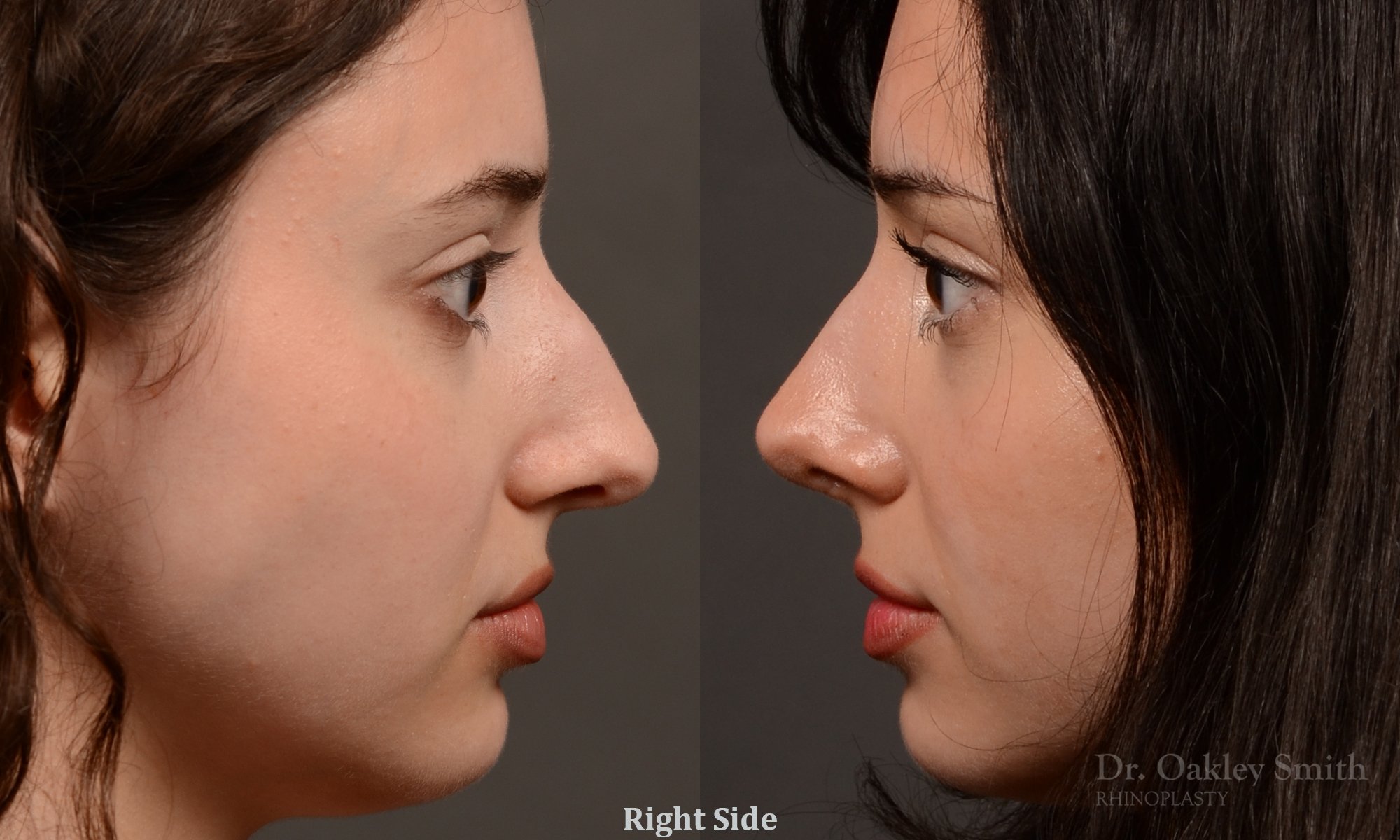 547:  Female, Primary Rhinoplasty, Bridge Narrowing, Tip work