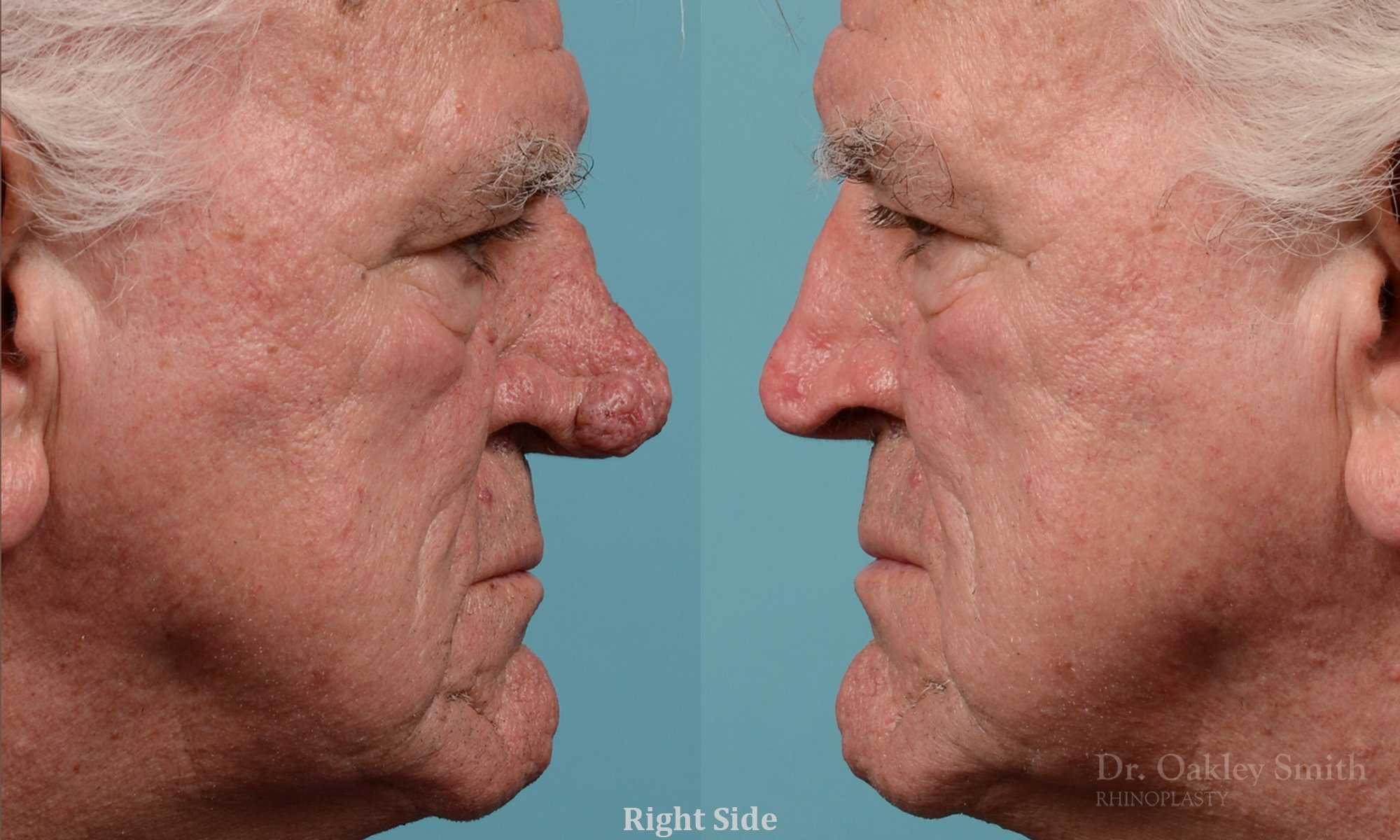 245C-rhinophyma-nose-job-rhinoplasty-dr-oakley-smith-toronto-1.jpg