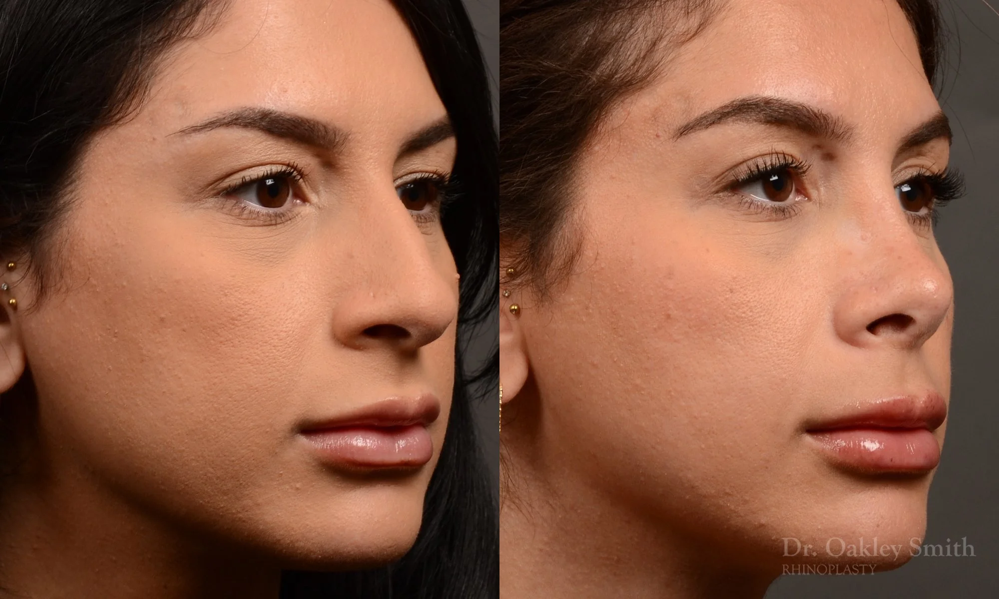 540B-rhinoplasty-dr-oakley-smith-toronto-nose-job.jpg