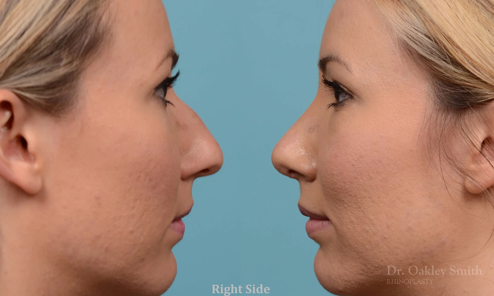 213C-rhinoplasty-toronto-dr-oakley-smith-big-nose-nose-job-curved-straight-profile-columellar-raised-1.jpg